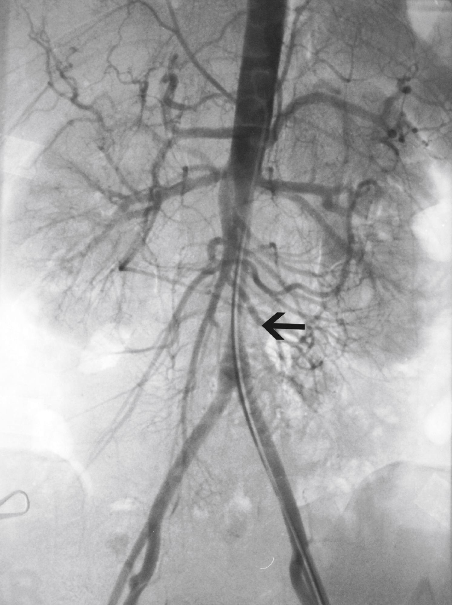 Figure 140.5, Abdominal aortogram of a 37-year-old hypertensive woman. Note the long, tapered stenosis of the infrarenal aorta (arrow) and sparing of the distal aorta and iliac arteries.