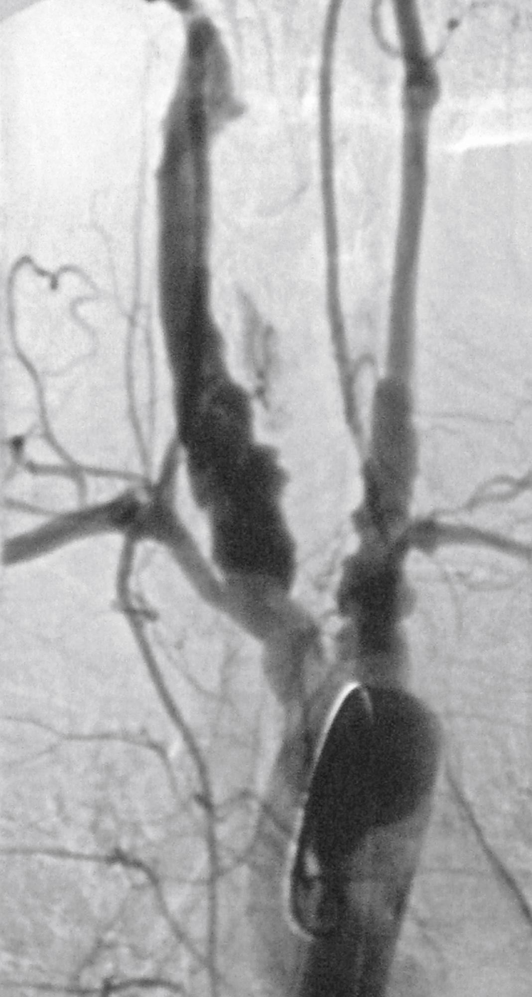 Figure 140.6, Aortic arch angiogram depicting extensive aneurysmal disease of the arch vessels of a 54-year-old man.