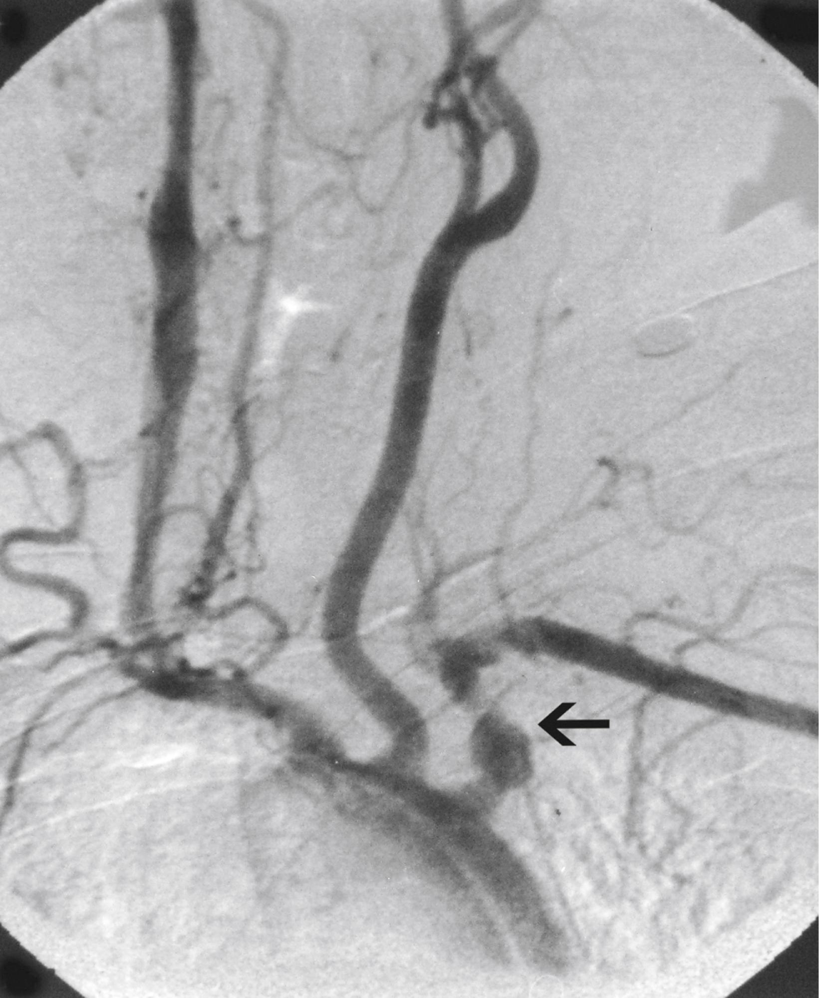 Figure 140.7, Aortic arch angiogram of a 33-year-old woman with left upper extremity claudication. Note the left subclavian aneurysm and concomitant distal stenosis (arrow) .