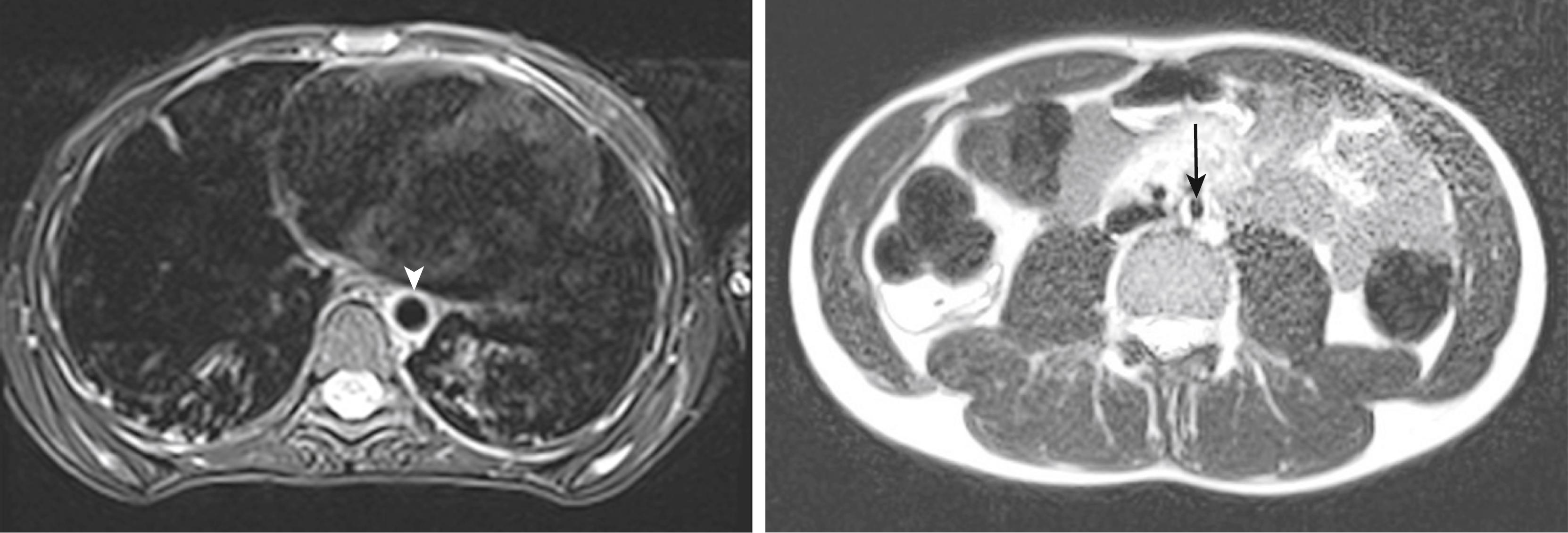 Fig. 37.1, A, MRI showing descending thoracic aorta with wall thickening and edema ( arrowhead ) in T2 sequence in a patient with Takayasu arteritis. B, MRI showing abdominal aorta narrowing with wall thickening and edema in T2 sequence ( arrow ) in a patient with Takayasu arteritis.