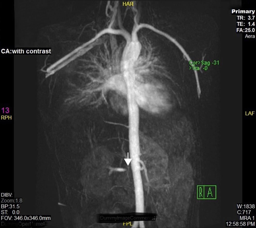 Fig. 37.2, MRA showing renal artery stenosis ( arrow ) in a patient with inflammatory bowel disease and associated Takayasu arteritis.