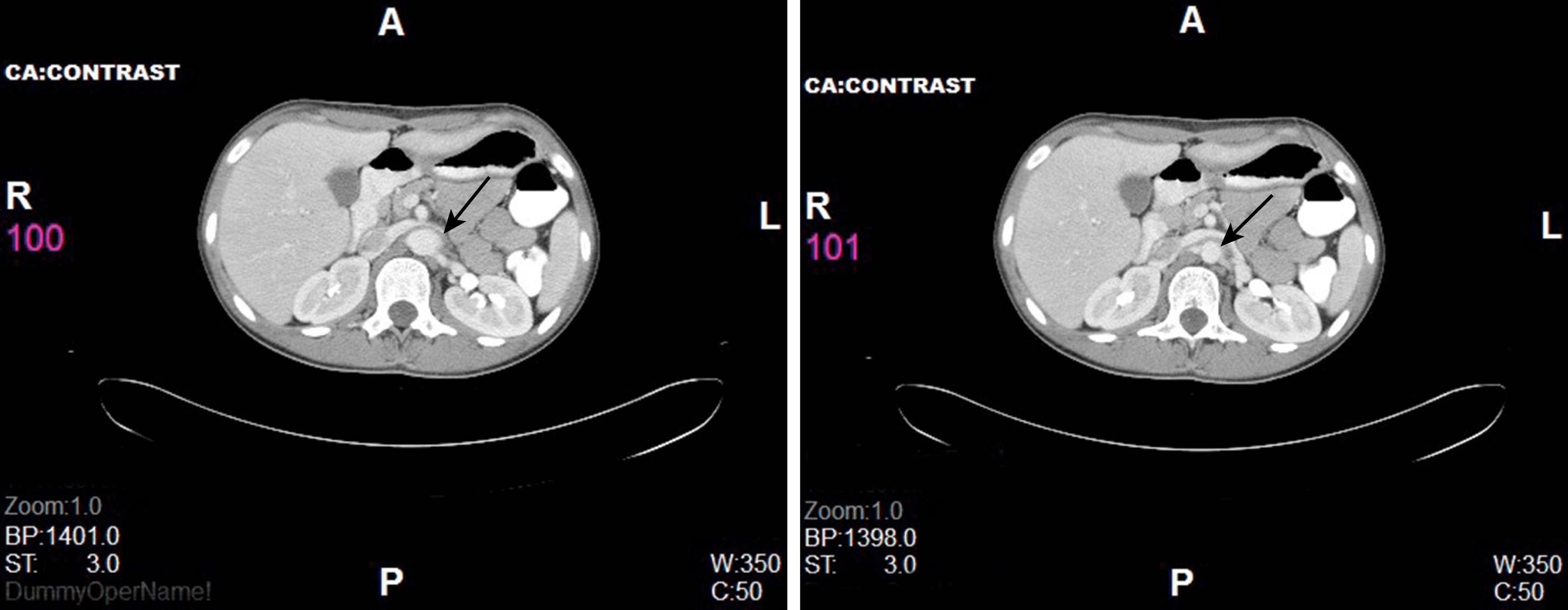 Fig. 37.3, Computed tomography angiography (CTA) showing aorta narrowing ( narrow on the right ) at the origin of the renal artery ( arrows ) in a patient with Takayasu arteritis.