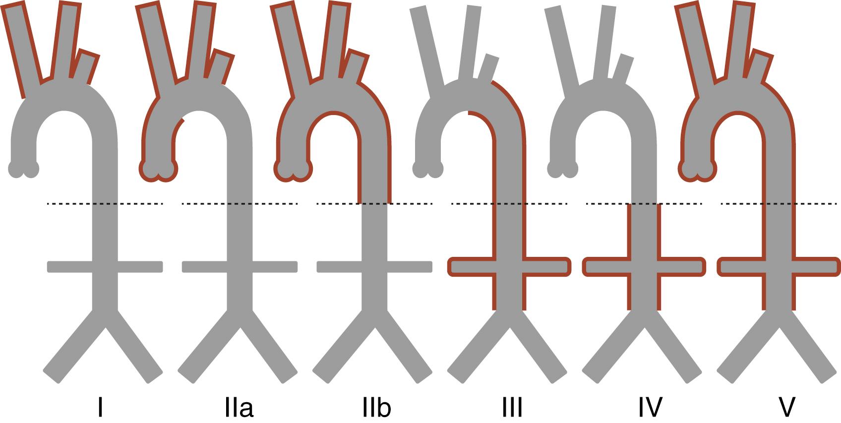 Fig. 37.4, Angiographic classification in Takayasu arteritis. [Reproduced (open access manuscript)