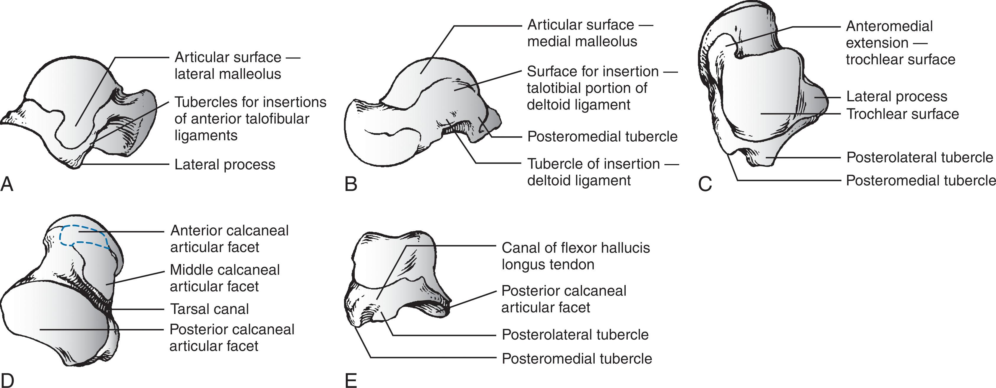 Fig. 46-1, Anatomy of the talus. Note its five surfaces. A , Lateral. B , Medial. C , Superior. D , Inferior. E , Posterior.