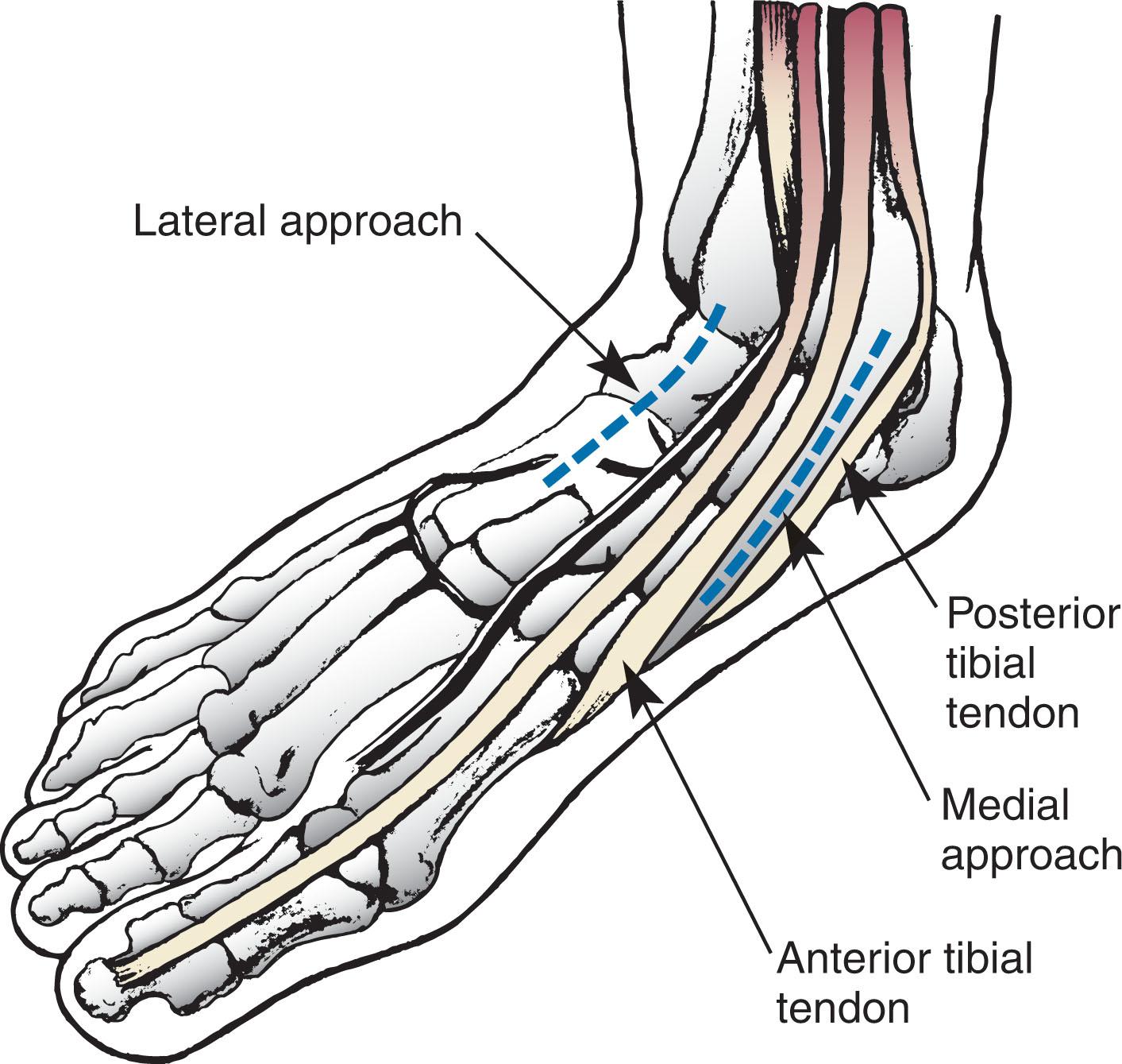 Fig. 46-11, Surgical approaches to the talus.