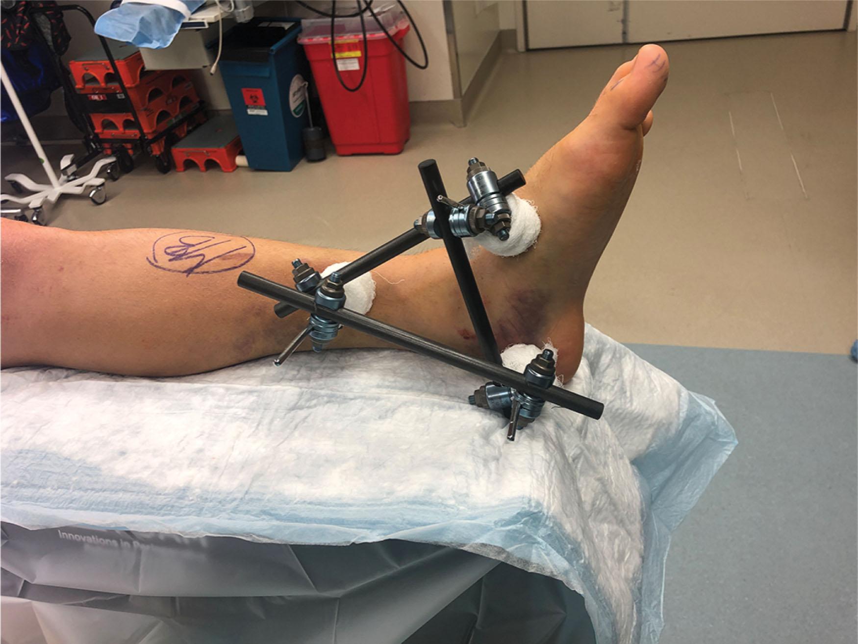 Fig. 46-12, A temporary external fixator is applied to the medial hindfoot spanning a displaced talar neck fracture. Pins are placed in the tibia, calcaneus, and navicular allowing distraction and reduction through ligamentotaxis.