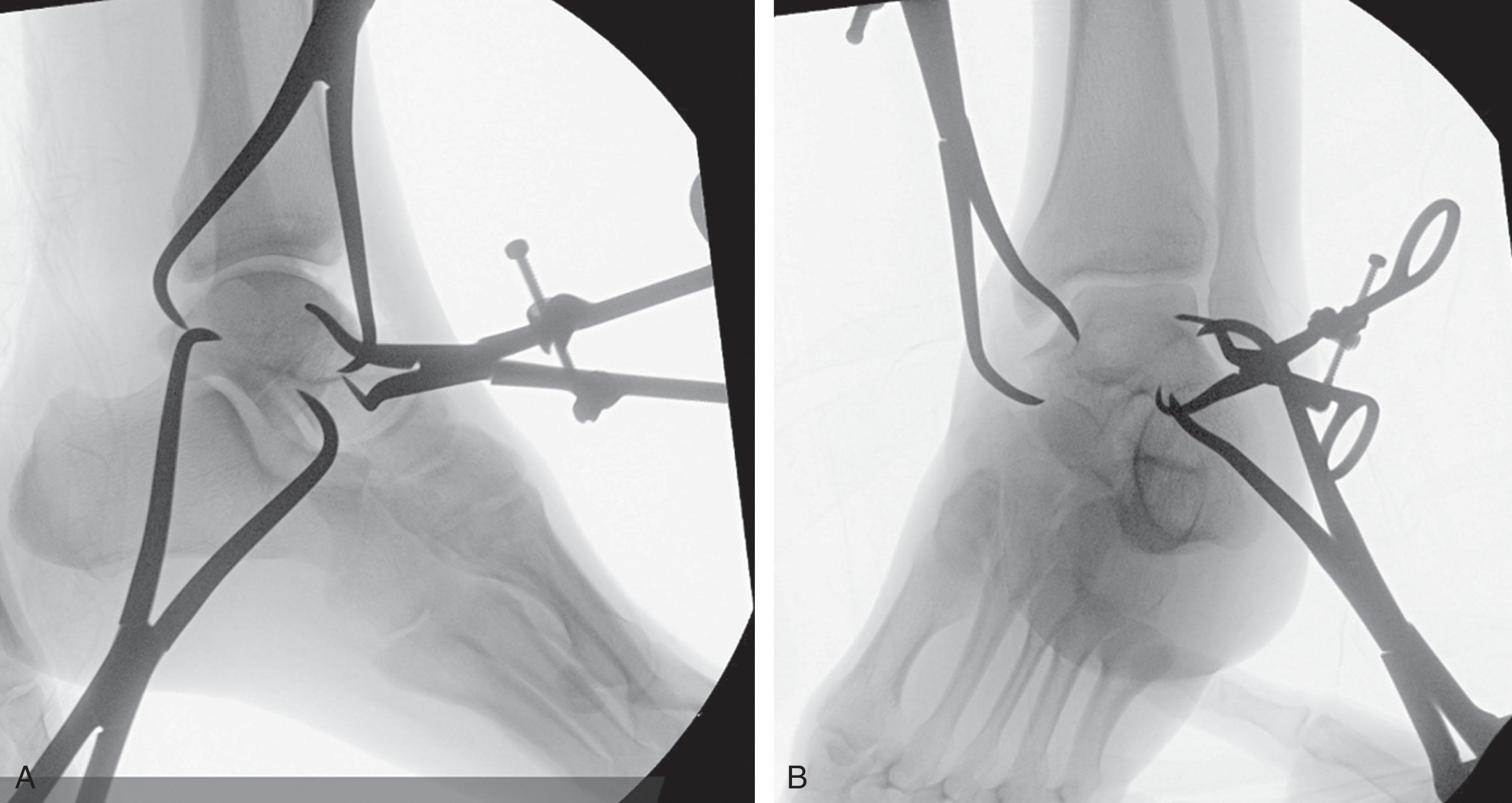 Fig. 46-13, A , Lateral and B , anteroposterior fluoroscopic views during reduction of a displaced talar neck fracture.