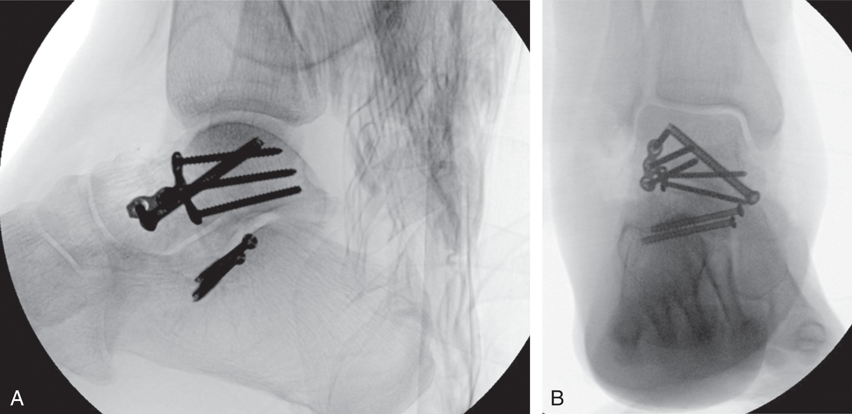 Fig. 46-14, A , Lateral and B , anteroposterior fluoroscopic views showing lateral plate fixation of the talar neck. A fully threaded medial talar neck screw is used to prevent overcompression, and additional screws were required in the calcaneus.