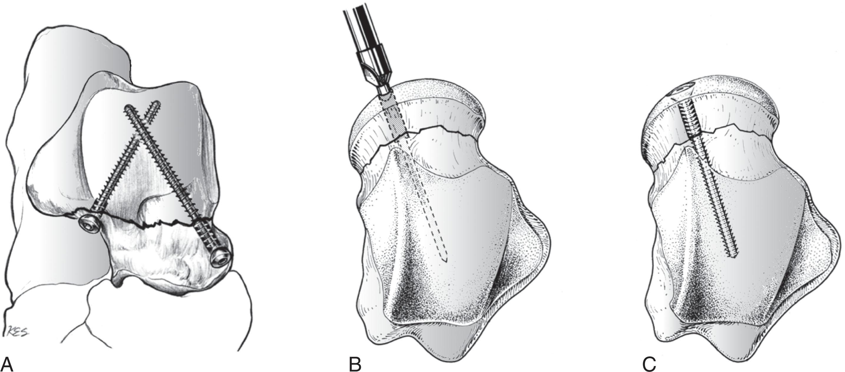 Fig. 46-15, Internal fixation of the talus with screws placed anterior to posterior. Screws may be parallel or, especially with comminution of the talar neck (A) , may be crossed. When screws must be inserted through the talar head, countersinking is critical ( B and C ).