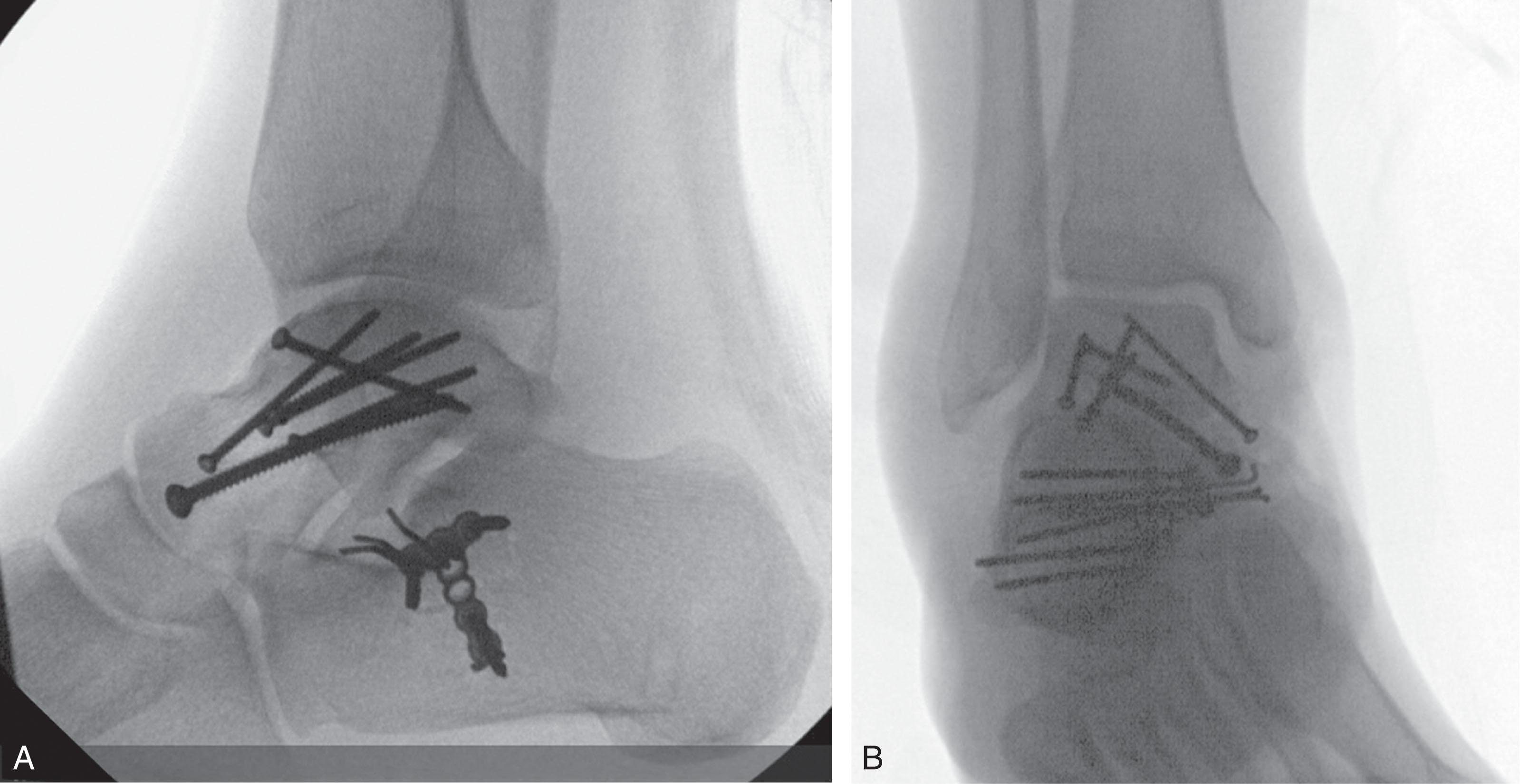 Fig. 46-16, (A) Lateral and (B) anteroposterior fluoroscopic views showing retrograde screw fixation of a displaced talar neck fracture.