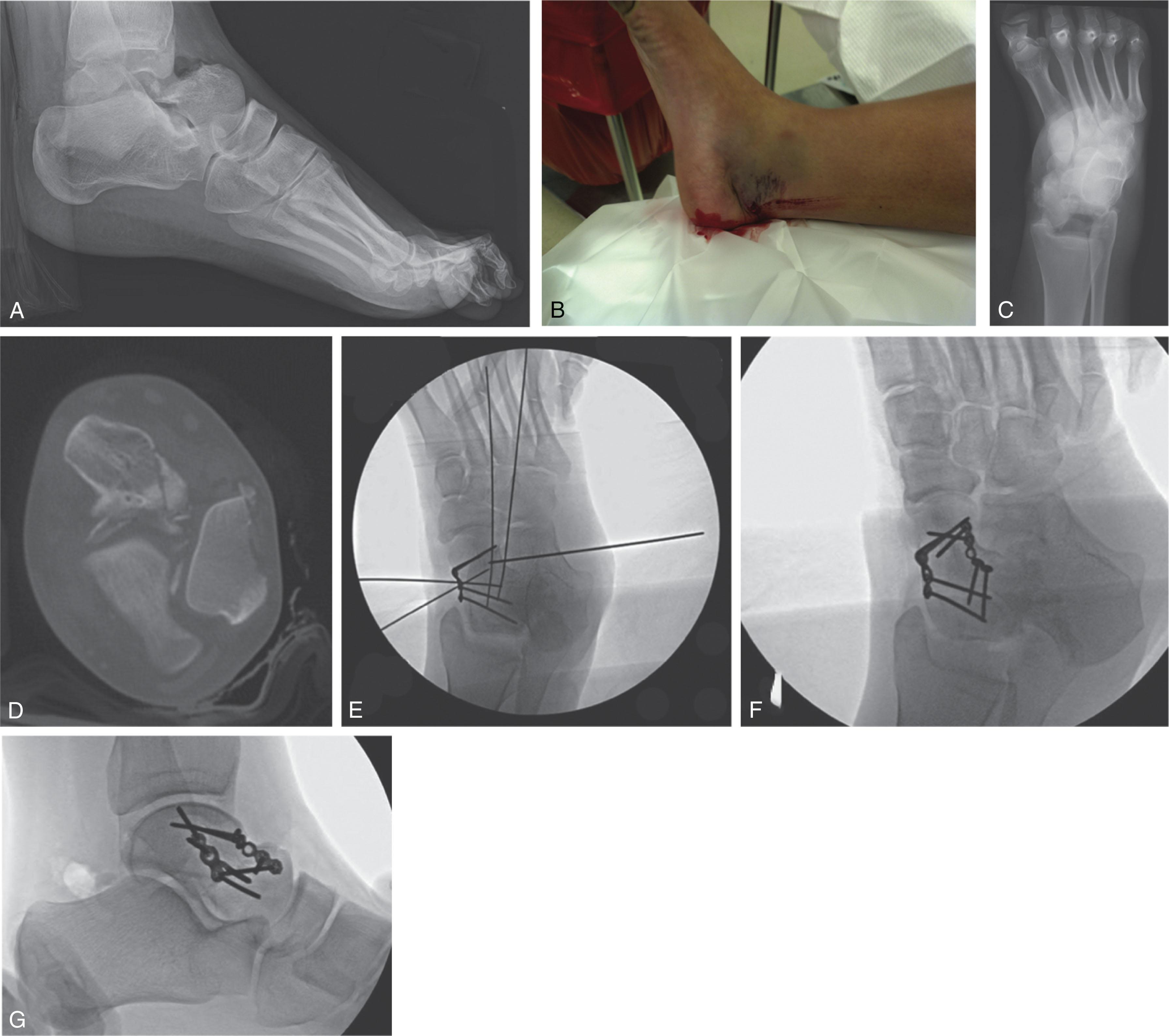 Fig. 46-17, A 20-year-old female sustained multiple fractures in a motor vehicle accident, including this open type III talar neck fracture as seen in the lateral radiograph (A) and photograph (B) . The talar body assumed a typical posteromedial location ( C and D ). The body was reduced through an extensile medial approach, and the patient underwent open reduction and internal fixation through two incisions (E to G) .