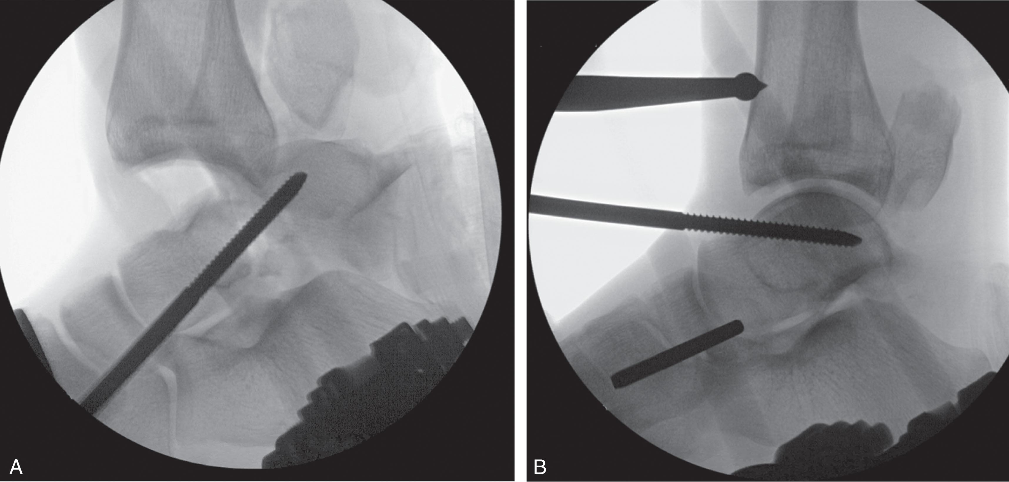 Fig. 46-18, Type III talar neck fracture with displaced talar body. A , Schantz pin is used to manipulate the talar body. B , The body has been reduced.