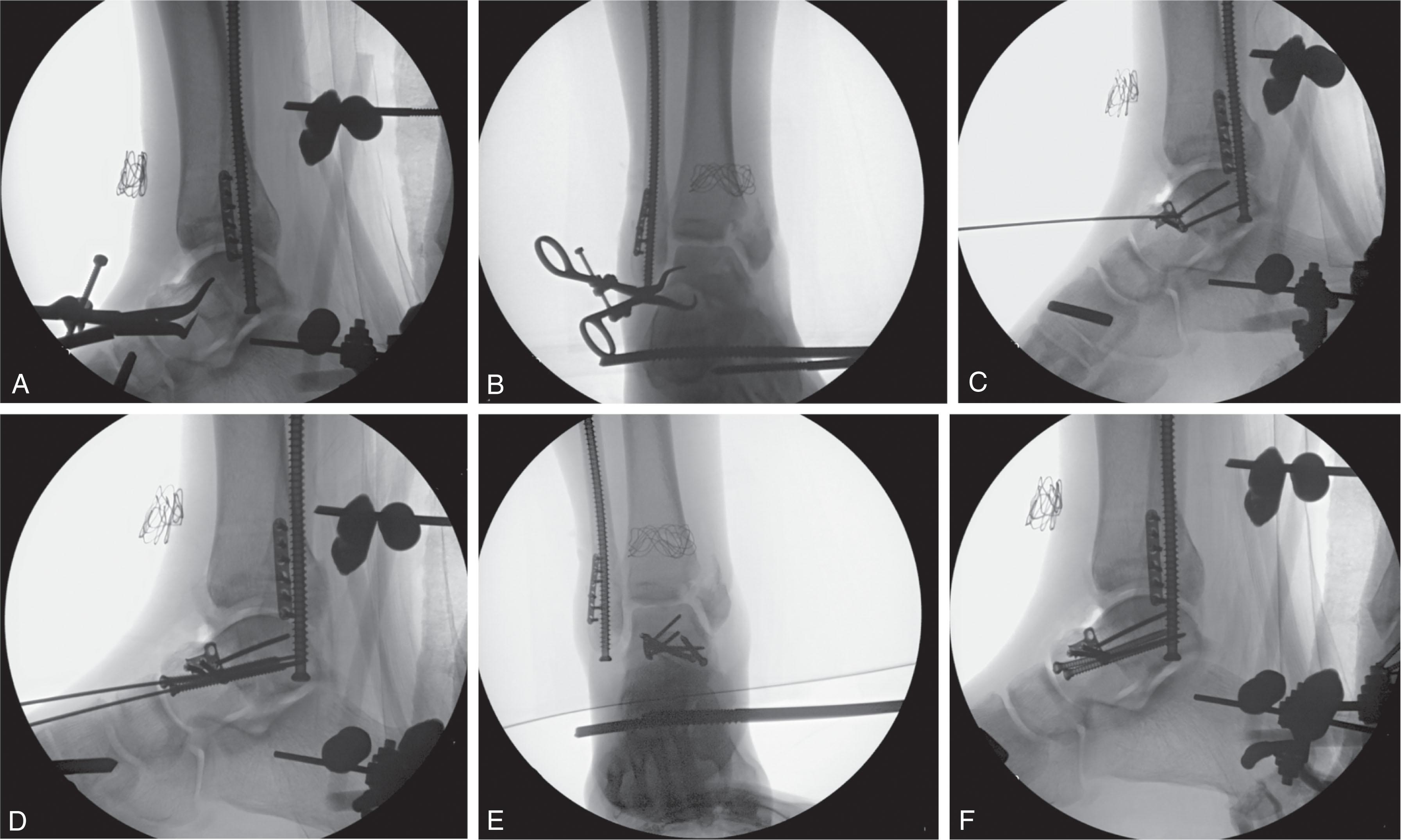 Fig. 46-19, Surgical sequence for type III talar neck fracture. A and B , The talar neck is reduced on the tension side with a reduction clamp. C , A lateral contoured plate is applied to the talar neck as a tension band. D , Fully threaded cannulated screws are placed to hold the medial column reduction. E and F , Final fluoroscopic views of the open reduction internal fixation.