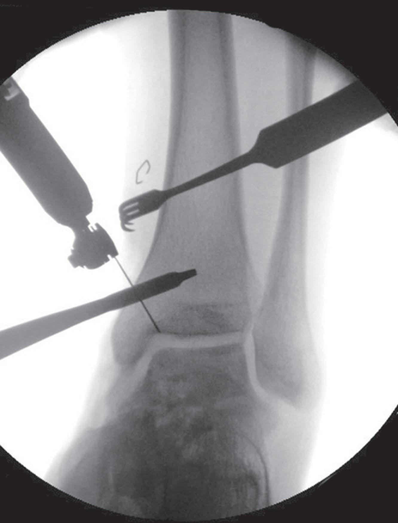 Fig. 46-20, With a type III talar neck fracture, a medial malleolar osteotomy is used as a last resort when a displaced talar body is not reducible.