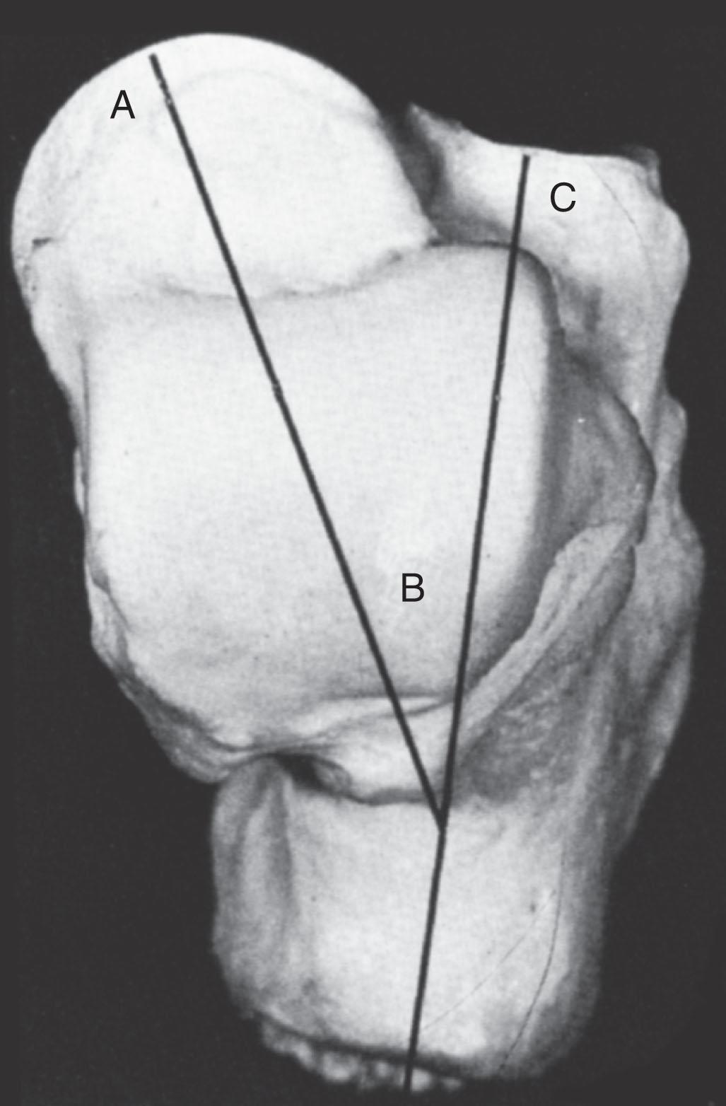 Fig. 46-2, The superior surface of the talus is shows. The talocalcaneal angle demonstrates medial deviation of the talus on the calcaneus, not only from the declination angle of the talar neck but also from the subtalar articulation.