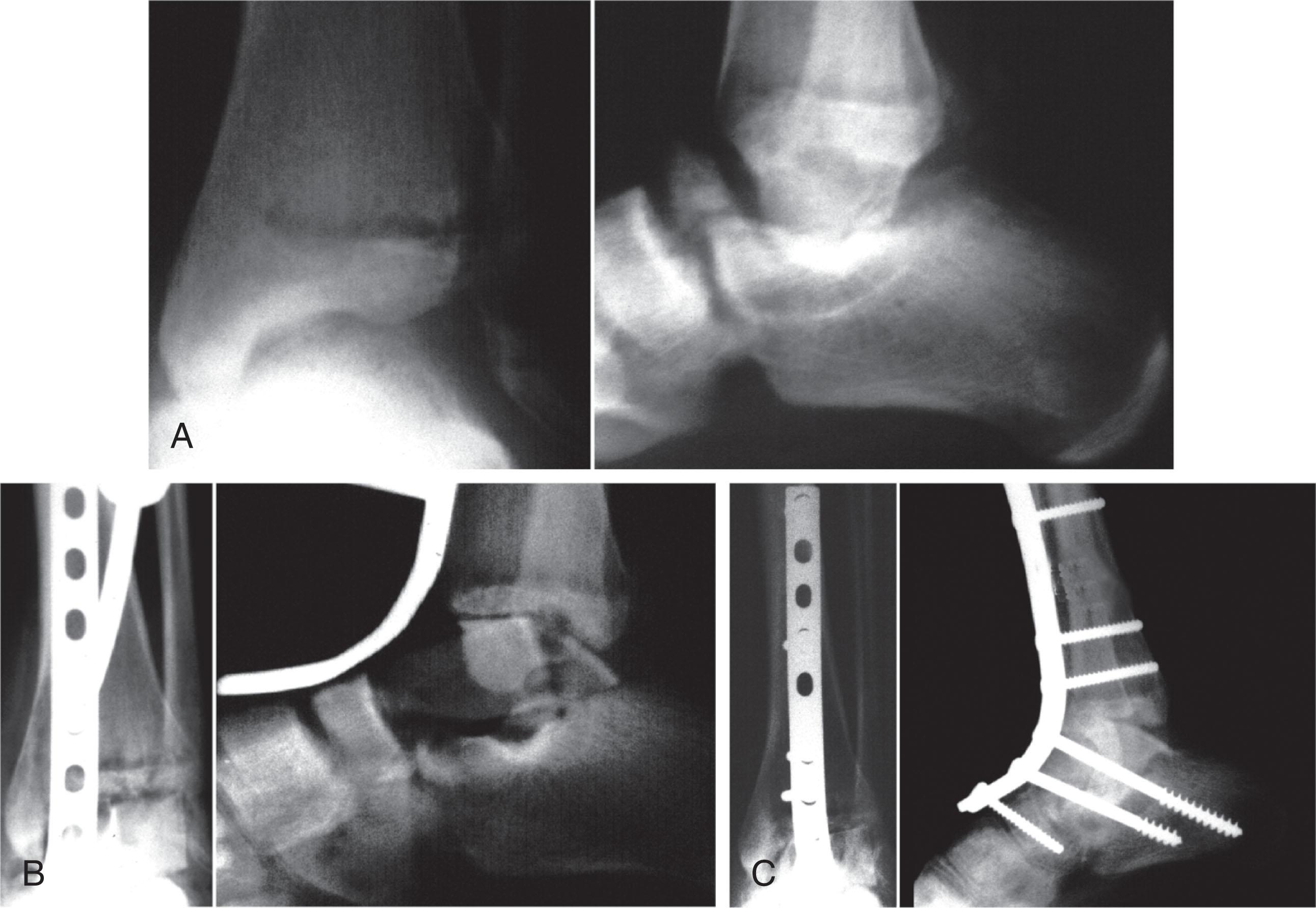 Fig. 46-22, A , Hawkins type III fracture-dislocation with loss of talar body at scene. B , After irrigation and debridement, patient underwent flap coverage and iliac crest bone grafting using an anterior plate. C , Nine months postoperatively, with solid pantalar fusion. Patient had a stiff lower extremity and was ultimately dissatisfied with the procedure because of pain and limited activity.