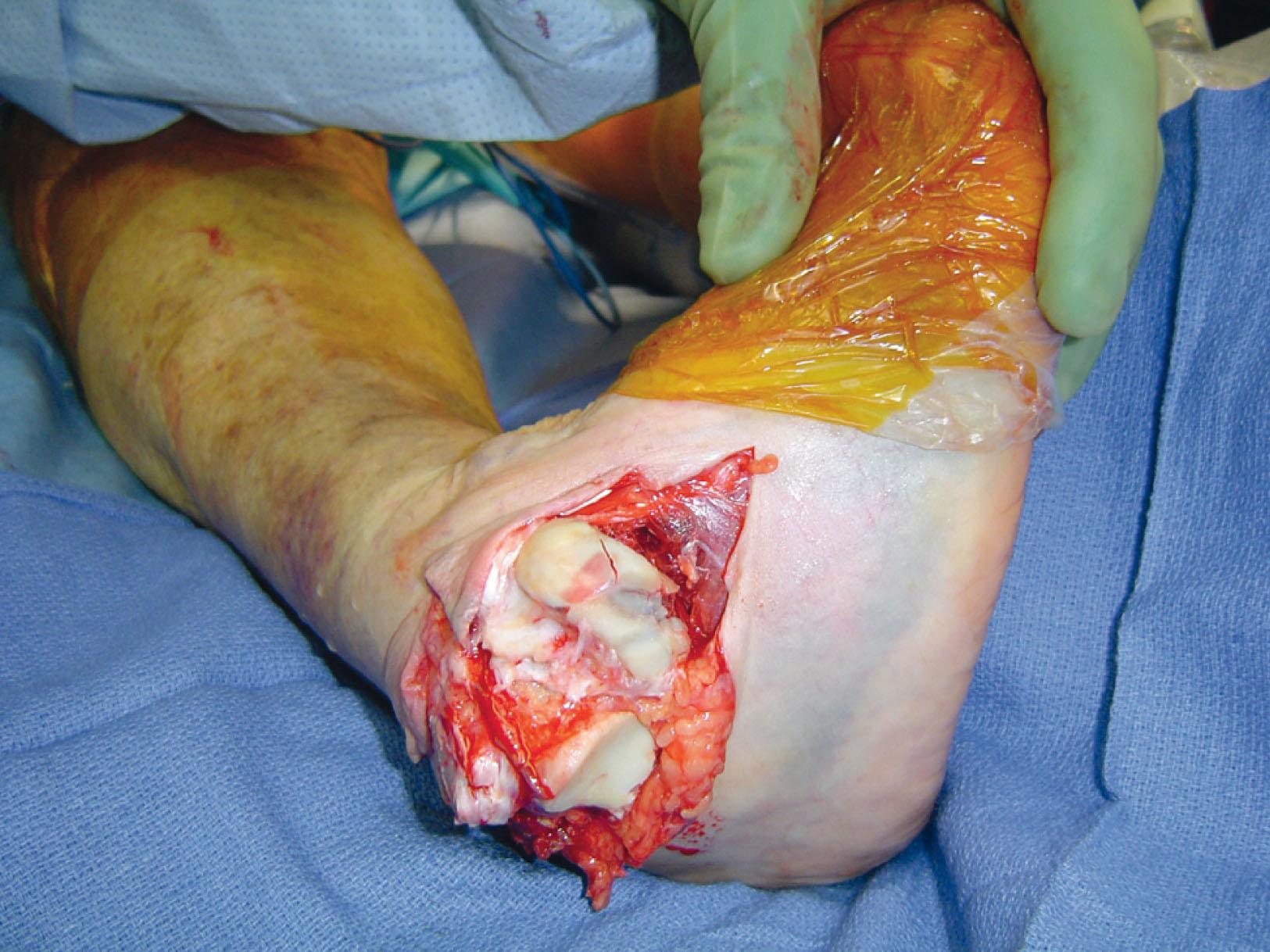 Fig. 46-23, Clinical photograph demonstrating an open subtalar dislocation with direct visualization of the subtalar and head articular surfaces of the talus. Note the anterolateral direction of the dislocation.