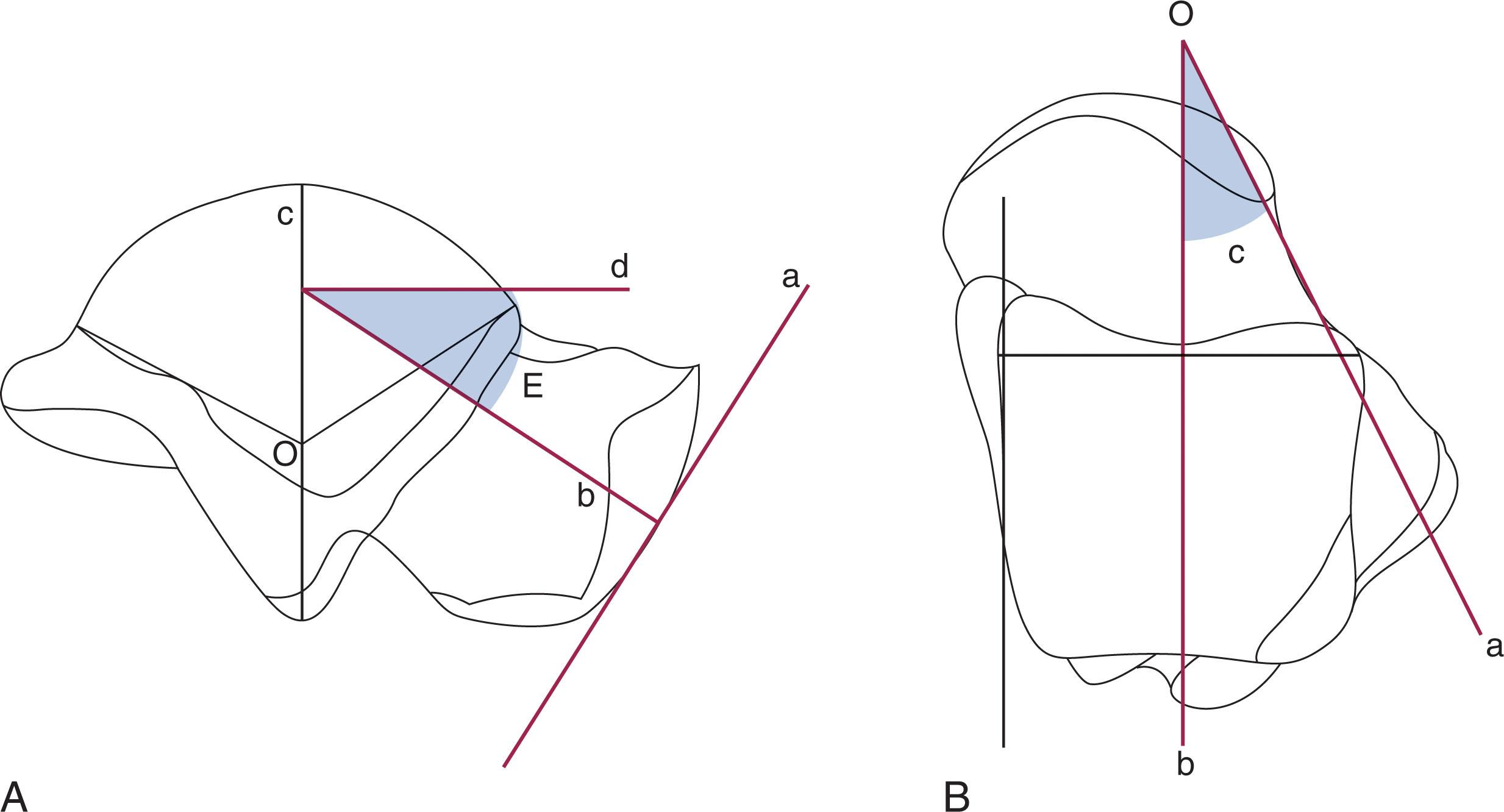 Fig. 46-3, Angles of inclination (A) and declination (B). A , Angle of inclination of the talar neck is measured by running a tangent to the head at the talonavicular joint (a) . The center of the trochlear arc is bisected (OC) , and a line is drawn perpendicular to it (d) . The line perpendicular to a is drawn (b) until it bisects OC . This forms the angle E , or the angle of inclination. B , Similarly, a line is drawn across the widest portion of the body; then a line is drawn perpendicular to it (bO) . A third line is then drawn along lateral edge of neck (aO) , forming angle c , or the angle of declination.