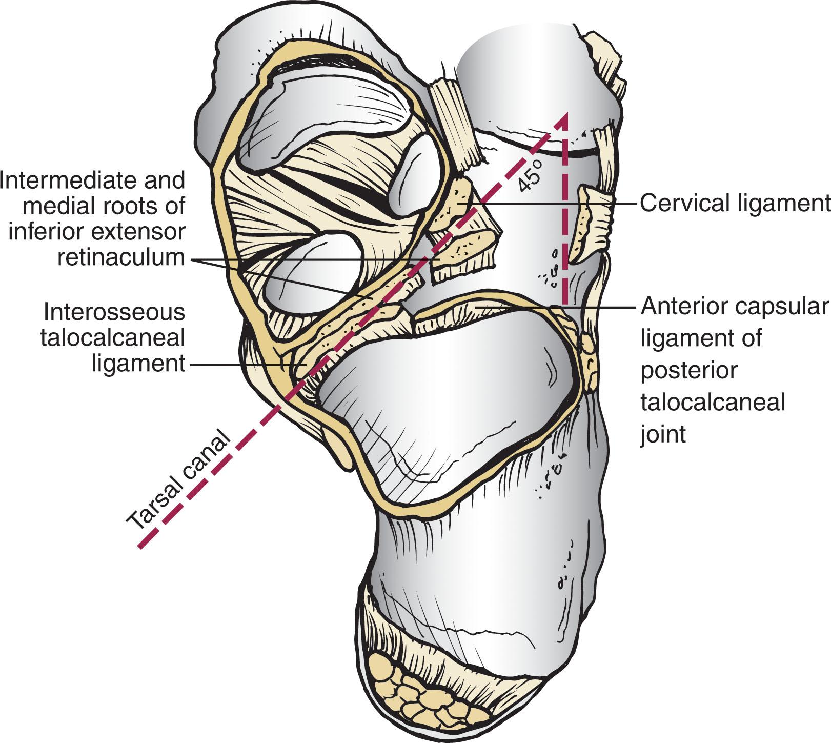 Fig. 46-4, Acetabulum pedis. This socket for the talar head allows the midfoot to swivel about the talar head and consists of the calcaneal middle and anterior surfaces connected to the large navicular articular surface by the inferior and superomedial calcaneonavicular ligaments.