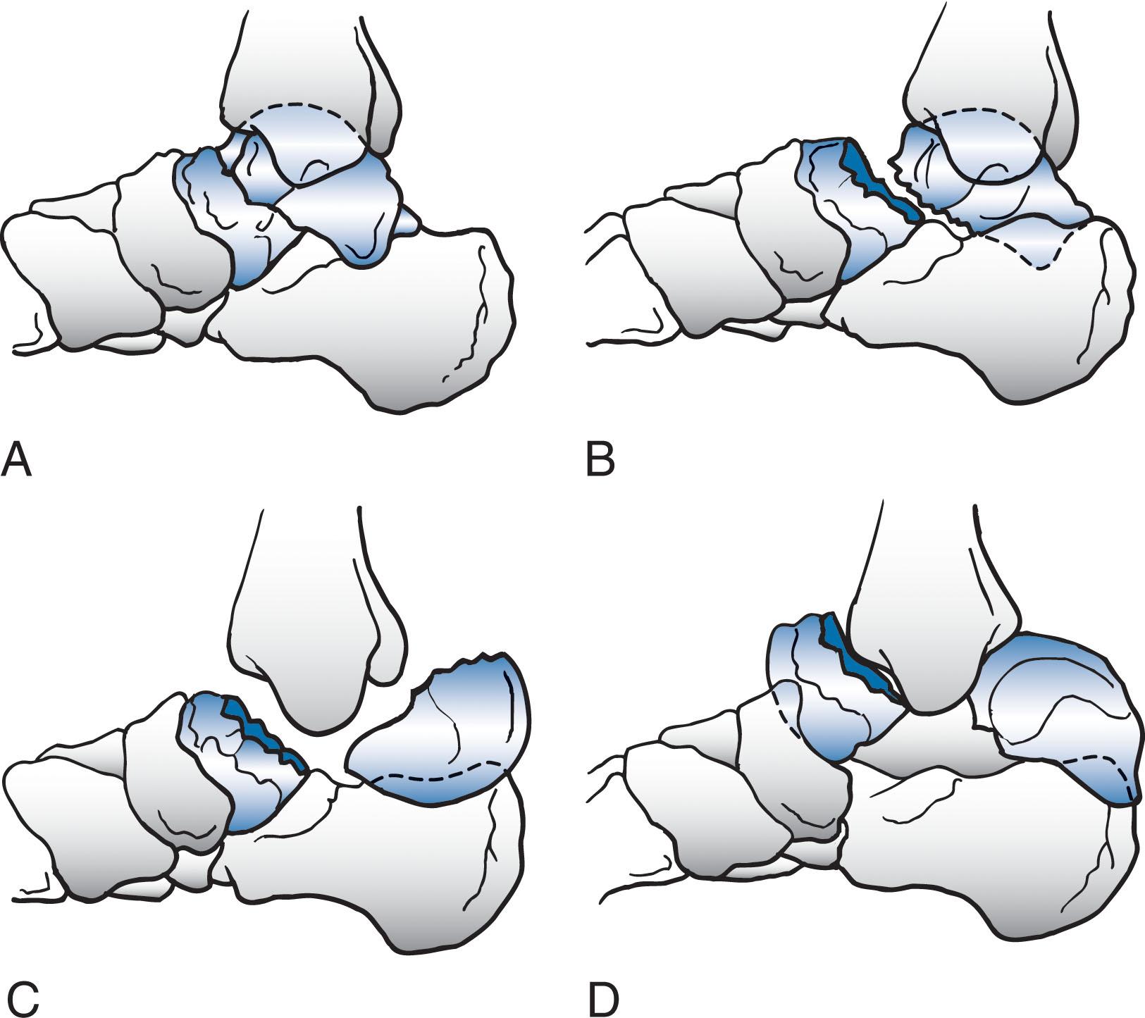 Fig. 46-6, Hawkins classification. A , Type I: nondisplaced talar neck fractures. B , Type II: displaced talar neck fractures, with subluxation or dislocation of the subtalar joint. C , Type III: displaced talar neck fractures with associated dislocation of the talar body from both subtalar and tibiotalar joints. D , Type IV (added by Canale and Kelly): displaced talar neck fracture with associated dislocation of the talar body from the subtalar and tibiotalar joints and dislocation of the head-and-neck fragment from the talonavicular joint.