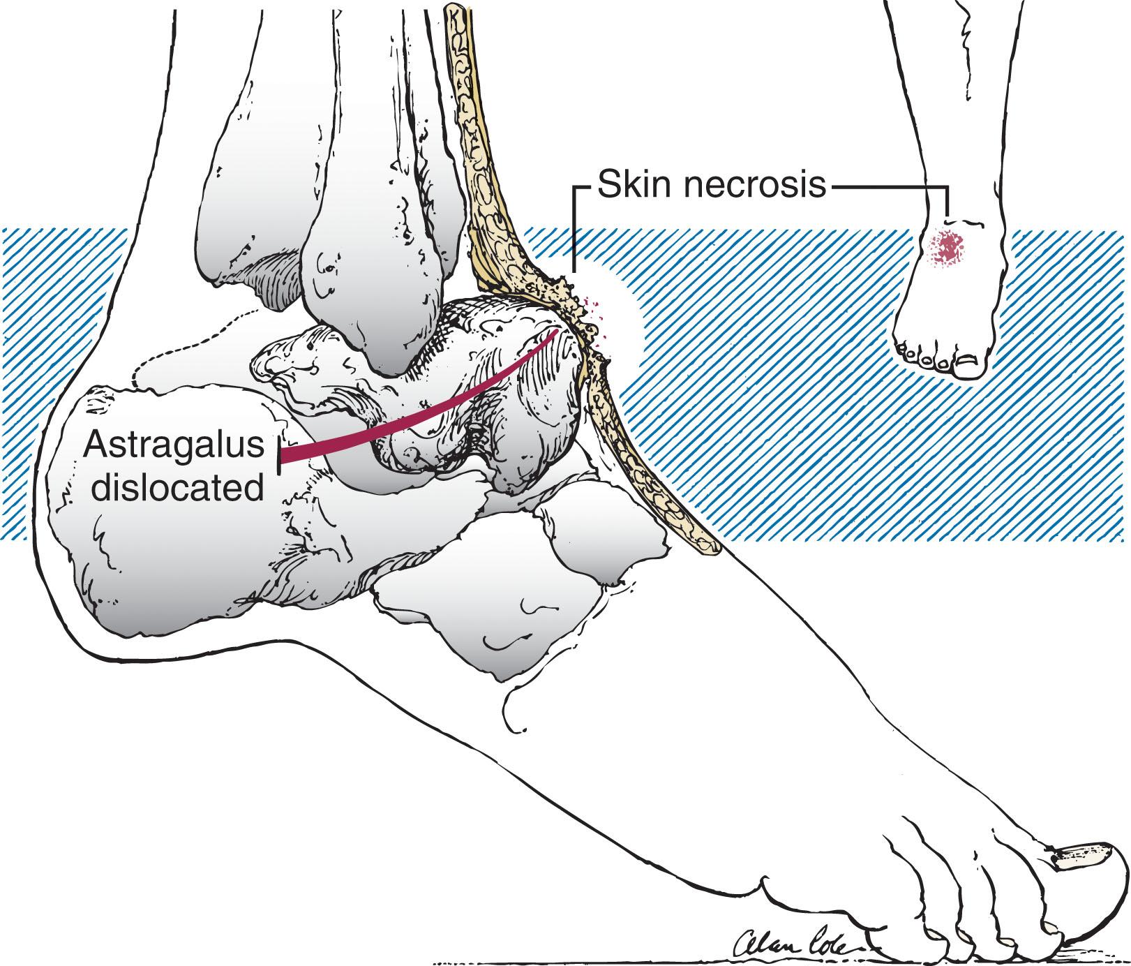 Fig. 46-8, Displacement of the talus against the skin causes pressure necrosis, which can lead to development of an open fracture. These bony protrusions must be evaluated and treated immediately.