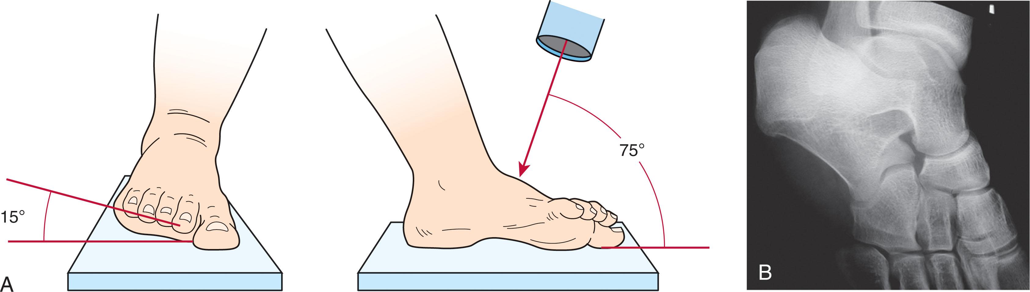 Fig. 46-9, A , The Canale view, as described by Canale and Kelly, is obtained by everting and plantar flexing the foot in relation to the x-ray beam. B , The resultant image should move the calcaneus out from underneath the talus to allow an unobstructed view of the talar neck.