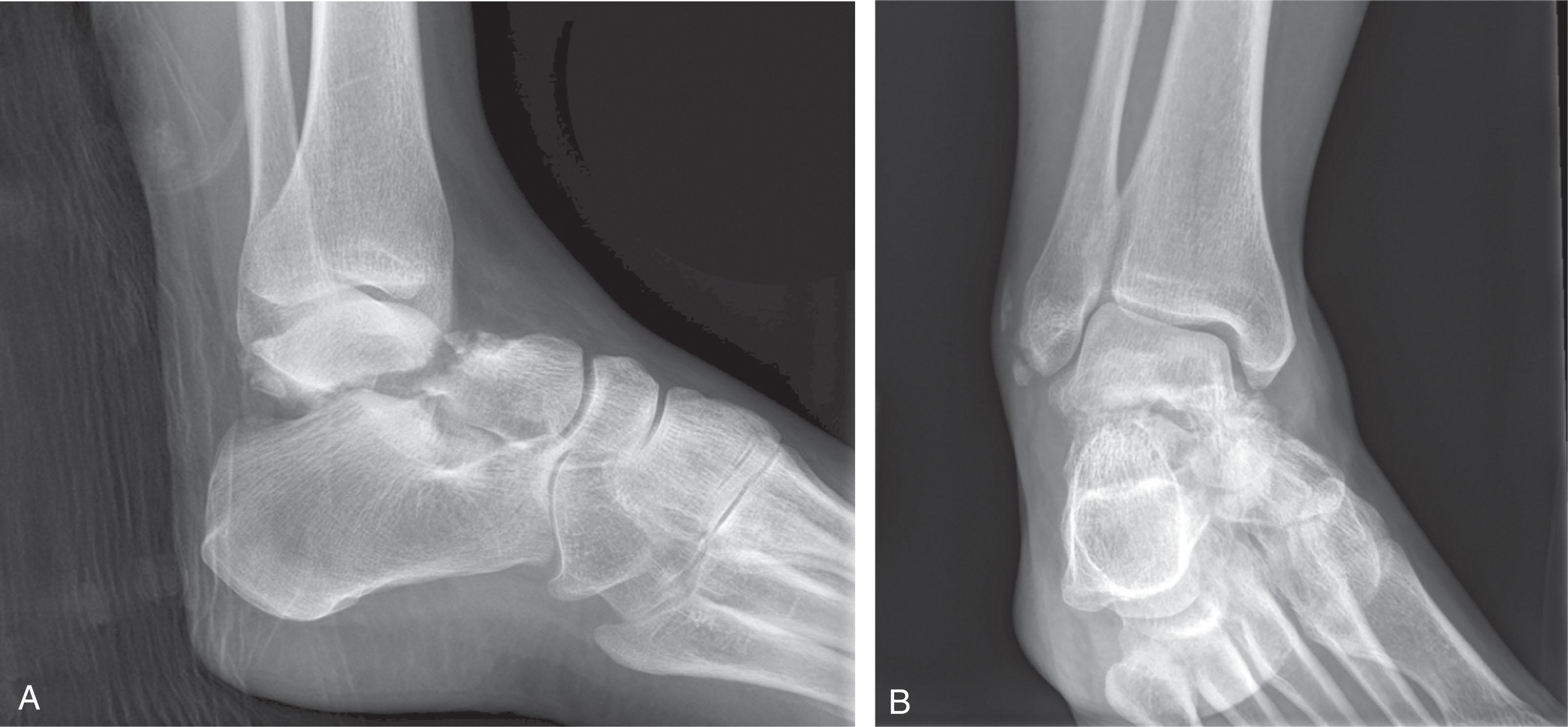 Fig. 46-10, A , Lateral and B , anteroposterior radiographs of a type II talar neck fracture. Note the displacement of the talar neck fracture and dislocation of the subtralar joint.