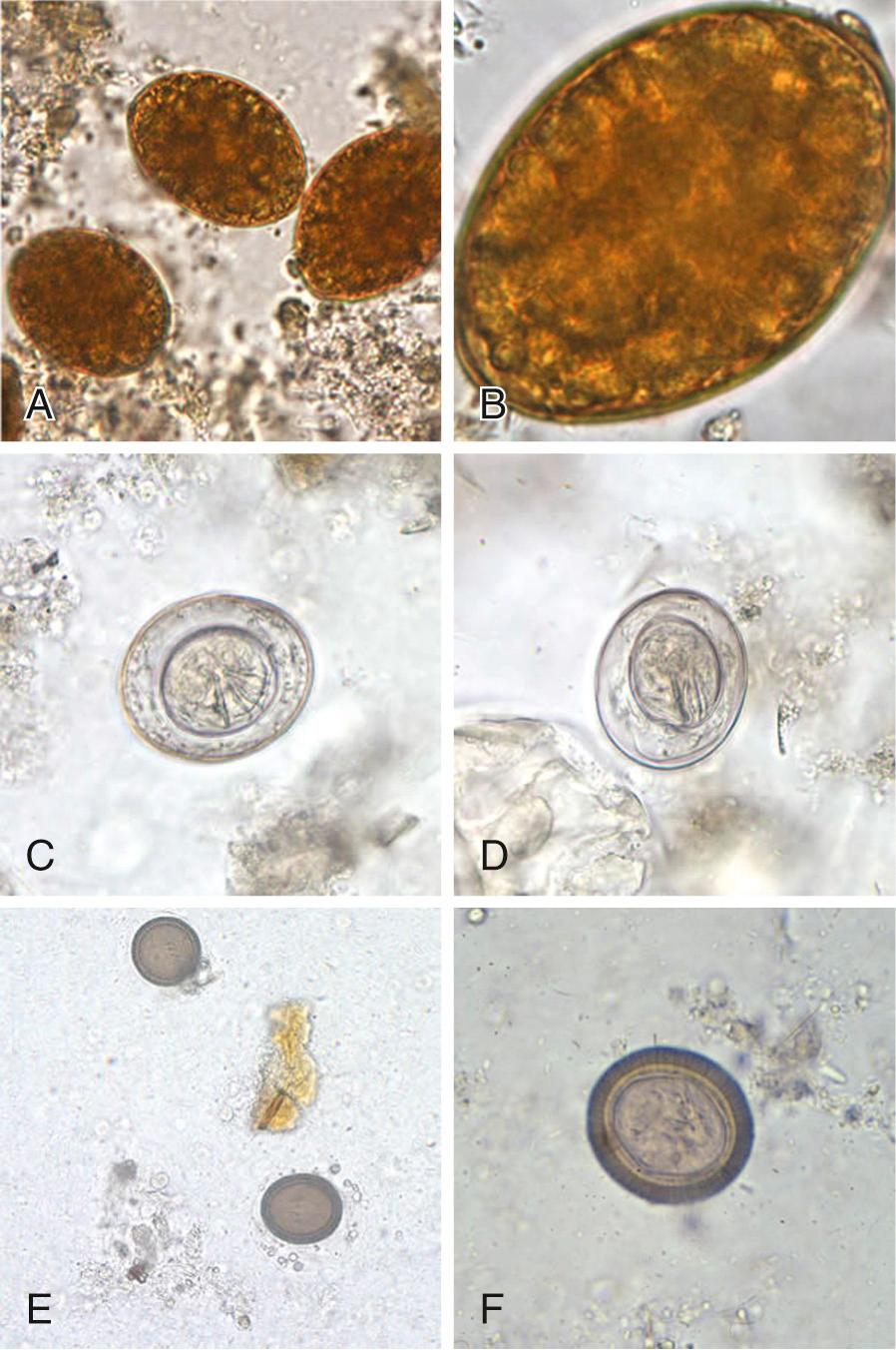 FIG. 289.3, (A–B) Eggs of Diphyllobothrium latum (55–75 µm × 40–50 µm) in an iodine-stained wet mount. Note the knob at the abopercular end in (B). (C–D) Eggs of Hymenolepis nana (30–50 µm) in an unstained wet mount. Note the presence of hooks in the oncosphere and polar filaments within the space between the oncosphere and outer shell. (E–F) Taenia spp. eggs (30–35 µm) in unstained wet mounts. The eggs of T. solium and T. saginata are indistinguishable from each other as well as from other members of the Taeniidae family.