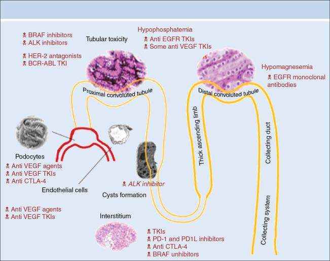 Fig. 17.1, Summary of renal adverse events noted with targeted therapies. ALK , Anaplastic lymphoma kinase; BCR-ABL , breakpoint cluster region–abelson; BRAF , v-RAF murine sarcoma viral oncogene homolog B; CTLA , cytotoxic T lymphocyte antigen−4; EGFR , epidermal growth factor receptor; HER -2, human epidermal growth factor−2; PD , programmed cell death; TKI , tyrosine kinase inhibitors; VEGF , vascular endothelial growth factor. Reproduced with permission from Jhaveri KD, Wanchoo R, Sakhiya V, Ross DW, Fishbane S. Adverse renal effects of novel molecular oncologic targeted therapies: a narrative review. Kidney Int Rep . 2016;2(1):108-123.