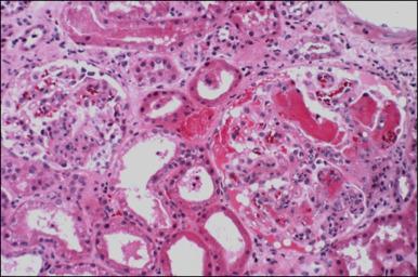 Fig. 17.2, A 56-year-old male with history of renal cell cancer receives bevacizumab presents with acute rise in creatinine, hypertension, and proteinuria. The kidney biopsy depicted shows acute thrombotic microangiopathy (light microscopy view).