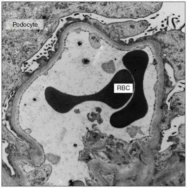 Fig. 17.3, A 78-year-old male with history of renal cell cancer receives sunitinib and presents with sudden onset nephrotic syndrome. The kidney biopsy depicted reveals minimal change nephropathy (electron microscopy view). RBC , Red blood cell.