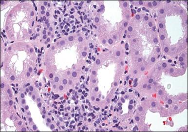 Fig. 17.7, A 78-year-old male with melanoma on vemurafenib presents with acute rise in serum creatinine, and the kidney biopsy depicted shows acute interstitial nephritis (light microscopy view).