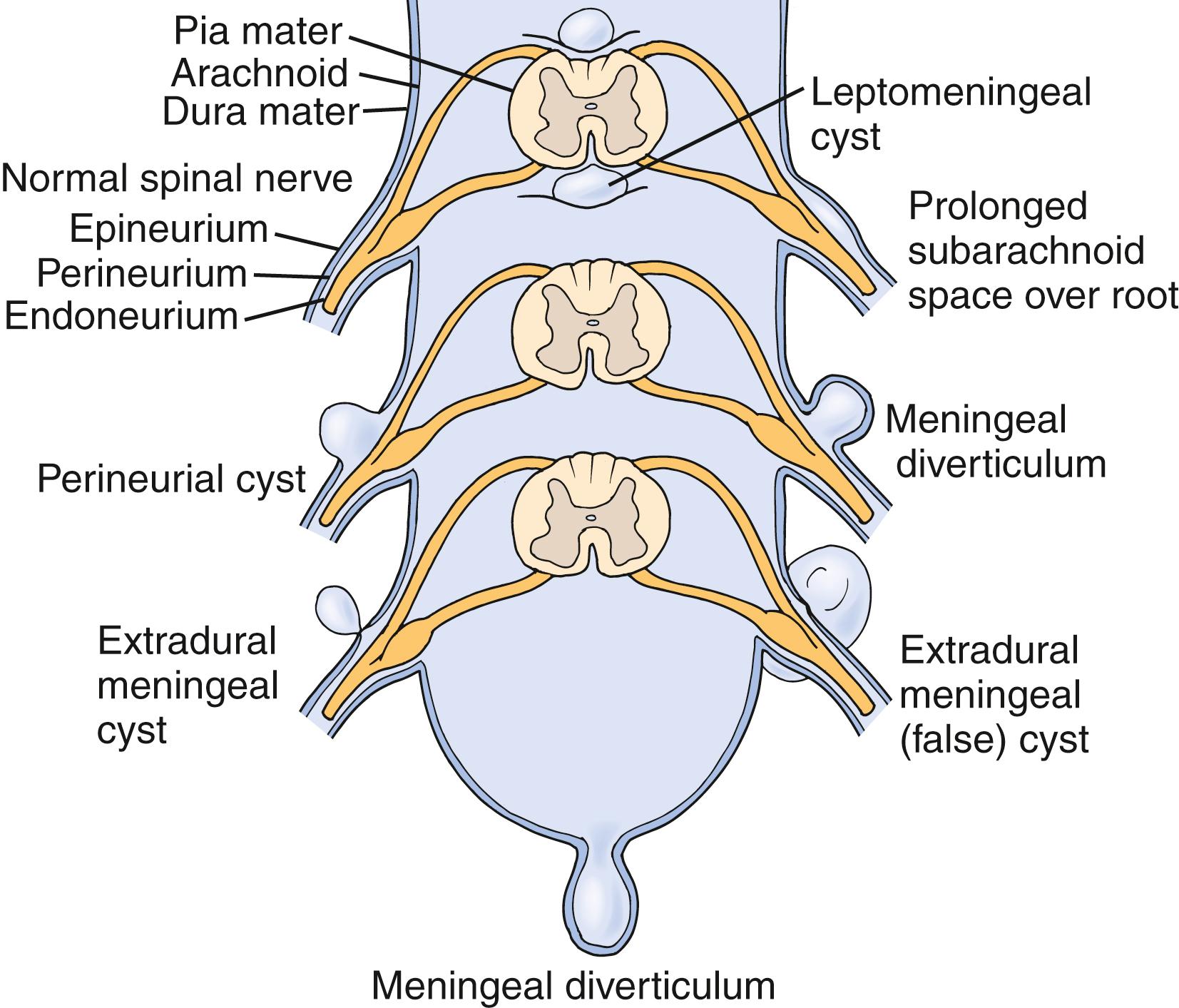 Fig. 26.1, An illustration of the different types of dural meningeal cysts, including the perineurial (Tarlov) cyst.