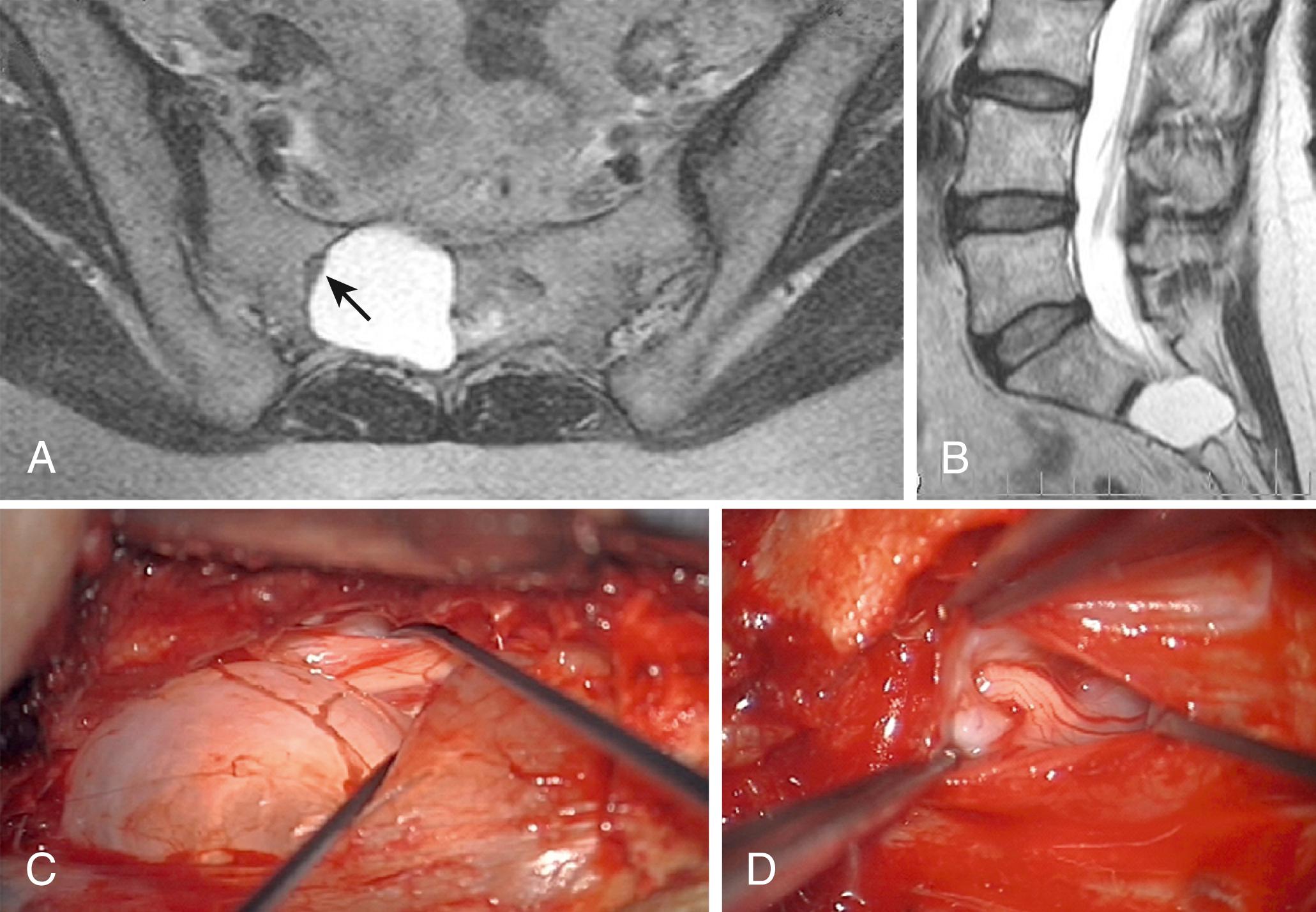 Fig. 26.2, Axial ( A ) and sagittal ( B ) T2-weighted sacral magnetic resonance imaging reveals a large Tarlov cyst in the S2 region central and rightward within the spinal canal. Its contents have imaging qualities similar to those of cerebrospinal fluid and there is widening of the spinal canal around it because of bone erosion. A compressed nerve root is seen adjacent to the cyst ( arrow ). C, Intraoperatively, the compressed nerve root (upper Penfield dissector) was visualized after retracting the cyst (lower Penfield dissector). The cyst was found to arise from the S3 nerve root, and the compressed nerve root was S2. D, View inside a Tarlov cyst. The nerve root fibers enter the cyst through the ostium and then splay out over the cyst wall.