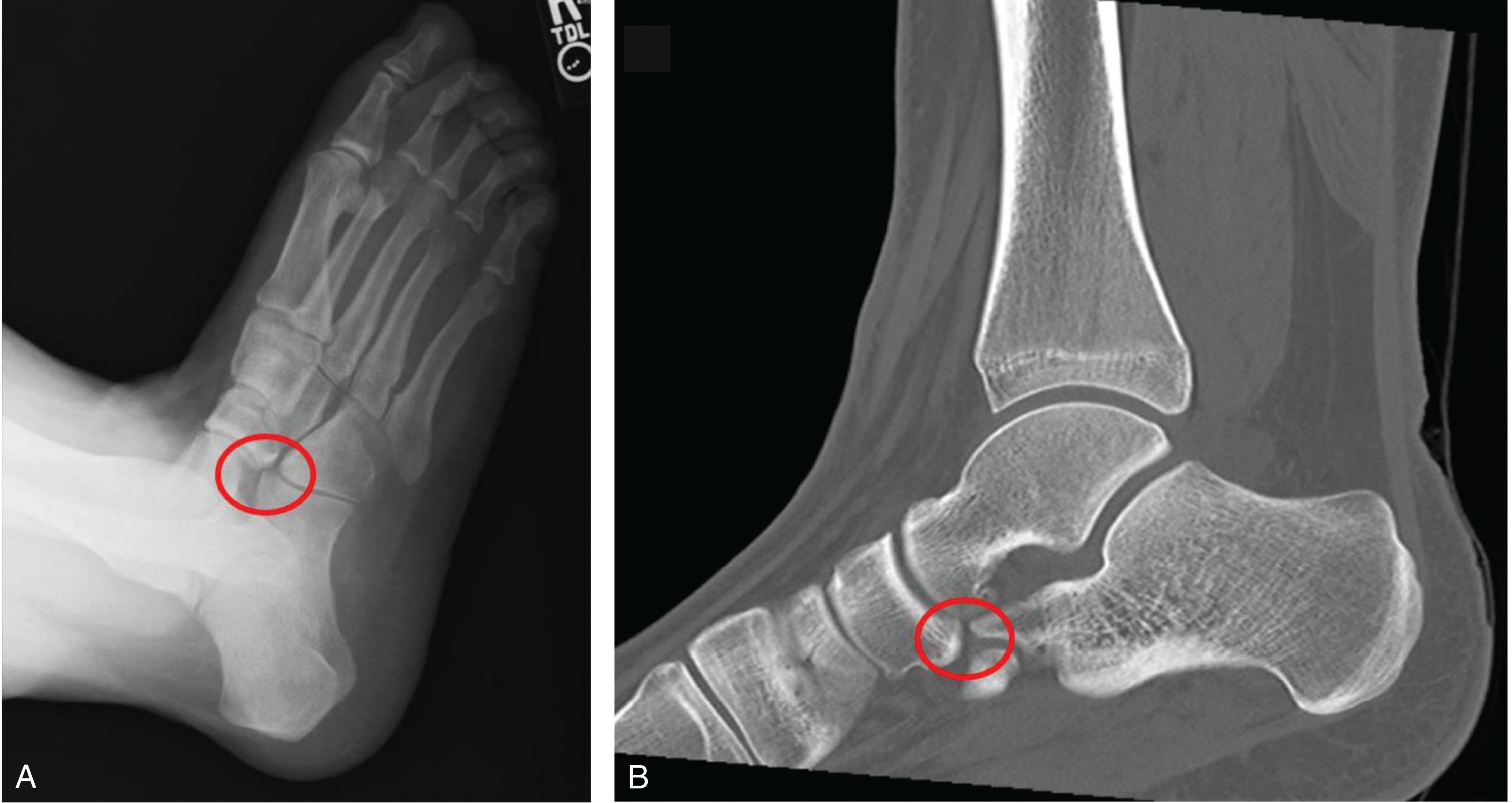 Fig. 36.1, (A) X-ray and (B) computed tomography scan of the foot showing nonosseous calcaneonavicular coalition.