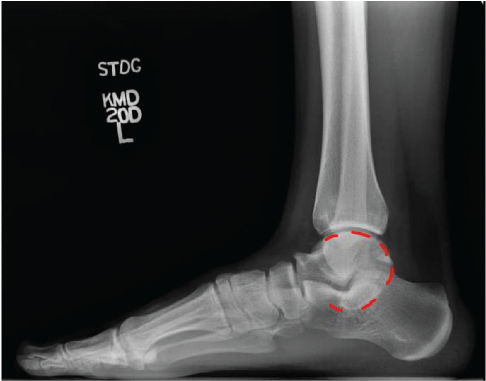 Fig. 36.2, Lateral X-Ray of the Foot. This shows talocalcaneal coalition as indicated by the C-sign