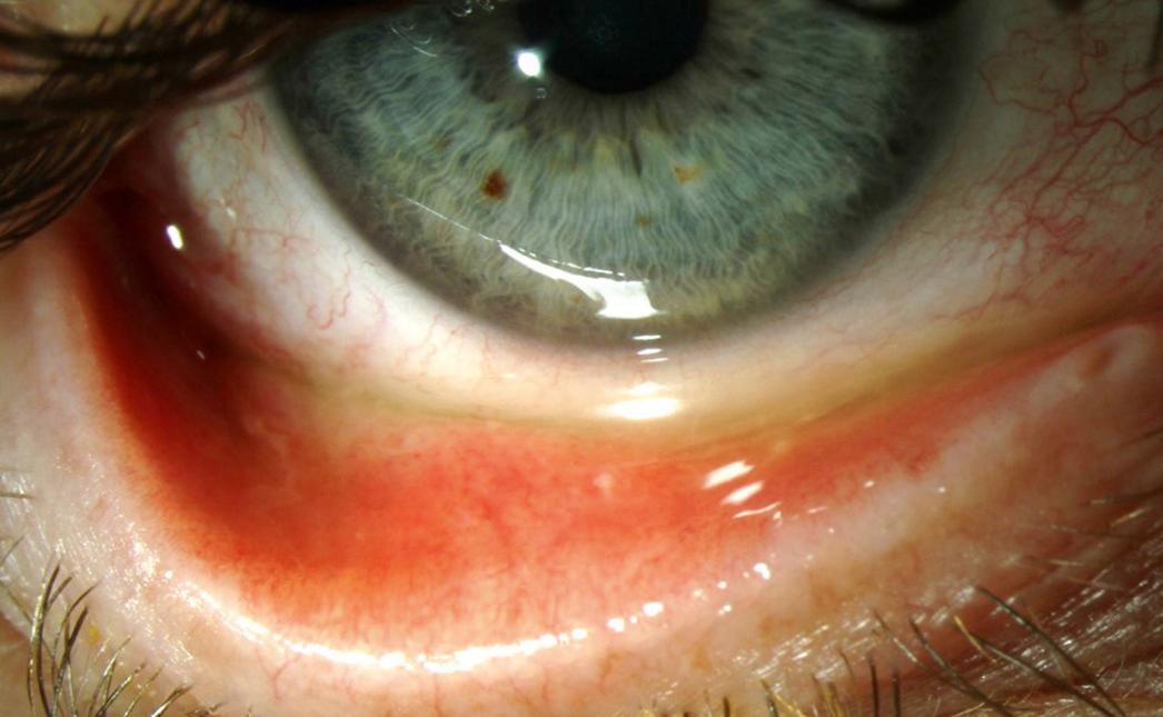 Fig. 8.6, Slit lamp photograph depicted small papillae on the inferior palpebral conjunctivae.