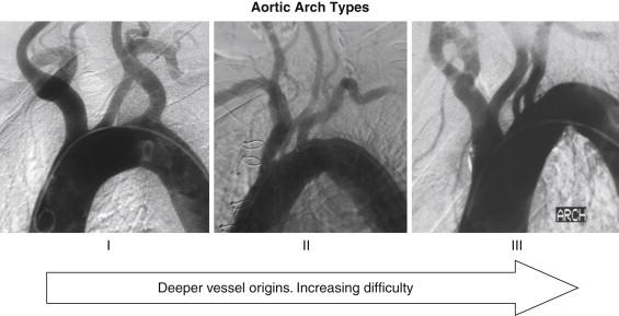 FIGURE 1, Assessment of the aortic arch. The type I aortic arch has branches originating from the top of the arch. As the arch becomes more tortuous, the branch vessel origins may be located on the upslope of the ascending aorta. The more inferiorly located and toward the patient’s right side the vessel origin is located, the more difficult the artery is to cannulate.