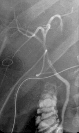 FIGURE 76-2, Radiopaque contrast via T tube showing regular biliary anatomy after transplantation of a deceased donor full-size graft.