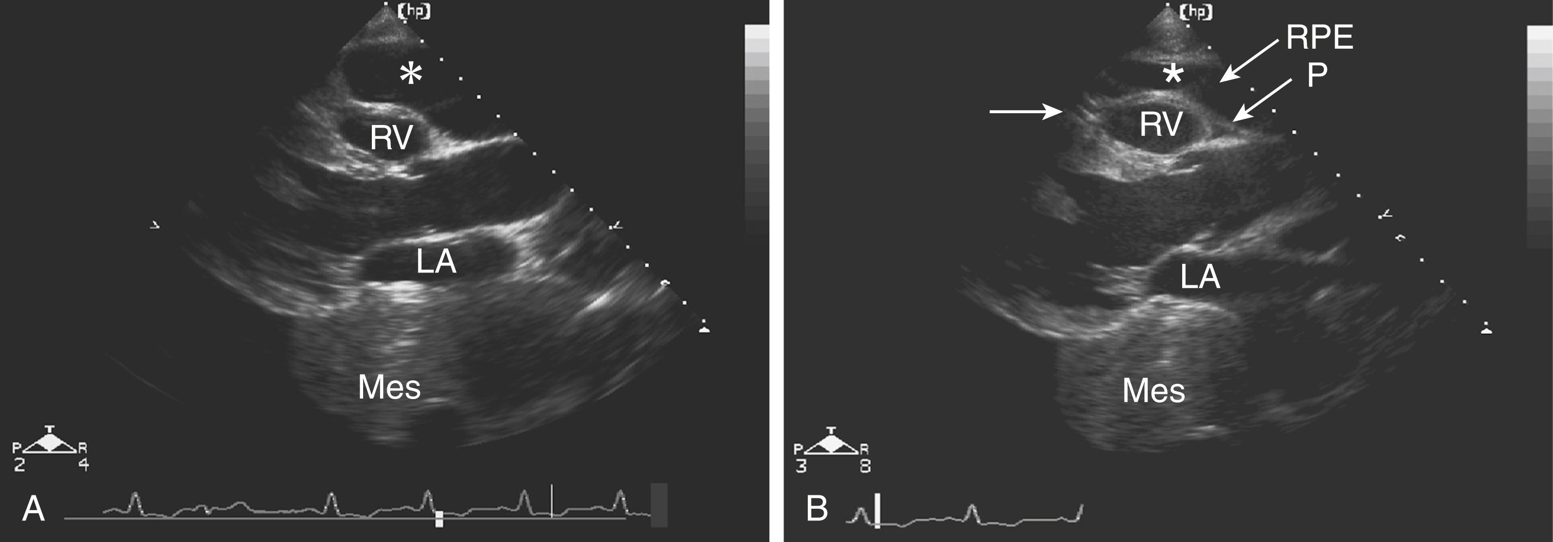 Figure 8.1, Systolic frames acquired from the parasternal long-axis view of the left ventricle in the same patient. An echo-free space (asterisk) is seen anterior to the right ventricle (RV), and a mesothelioma (Mes) is seen posterior to the left atrium (LA). A, In an image acquired using a transducer frequency of 3 MHz, the echo-free space anterior to the RV appears to be a pericardial effusion. B, In an image acquired using a transducer frequency of 5 MHz, the distinction between the pericardium (P) and pleural space can be appreciated, thus identifying the echo-free space as a right pleural effusion (RPE) rather than as a pericardial effusion. Also see accompanying Video 8.1 .