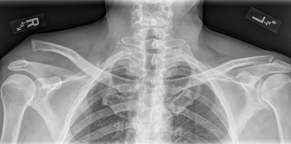 Fig. 14.1, Preoperative (panoramic) Zanca view.