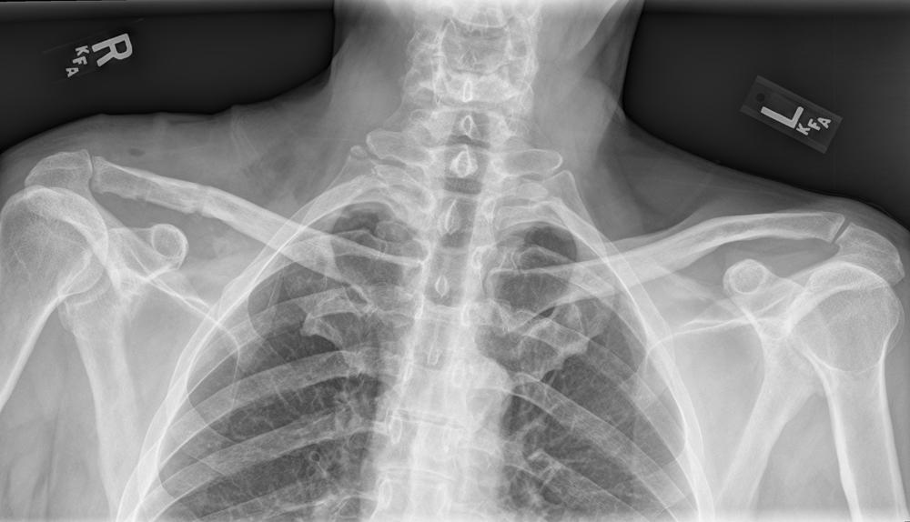 Fig. 14.2, Postoperative (panoramic) Zanca view.