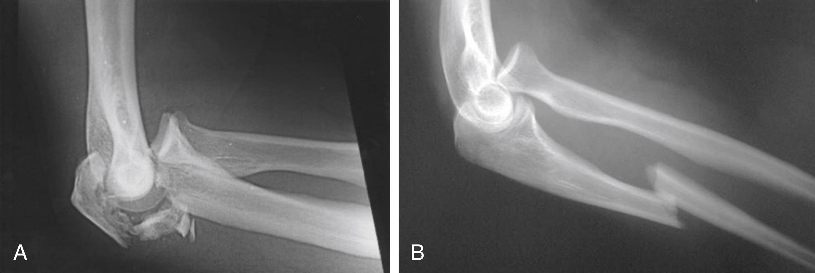 Fig. 54.1, (A) Lateral radiograph of an anterior (transolecranon) olecranon fracture-dislocation. The radioulnar relationship is intact and the entire forearm is subluxated anteriorly. There is impaction in the depths of the trochlear notch. (B) Lateral radiograph of an anterolateral Monteggia injury: diaphyseal fracture of the ulna with anterolateral dislocation of the radial head from the proximal radioulnar and radiocapitellar joints.