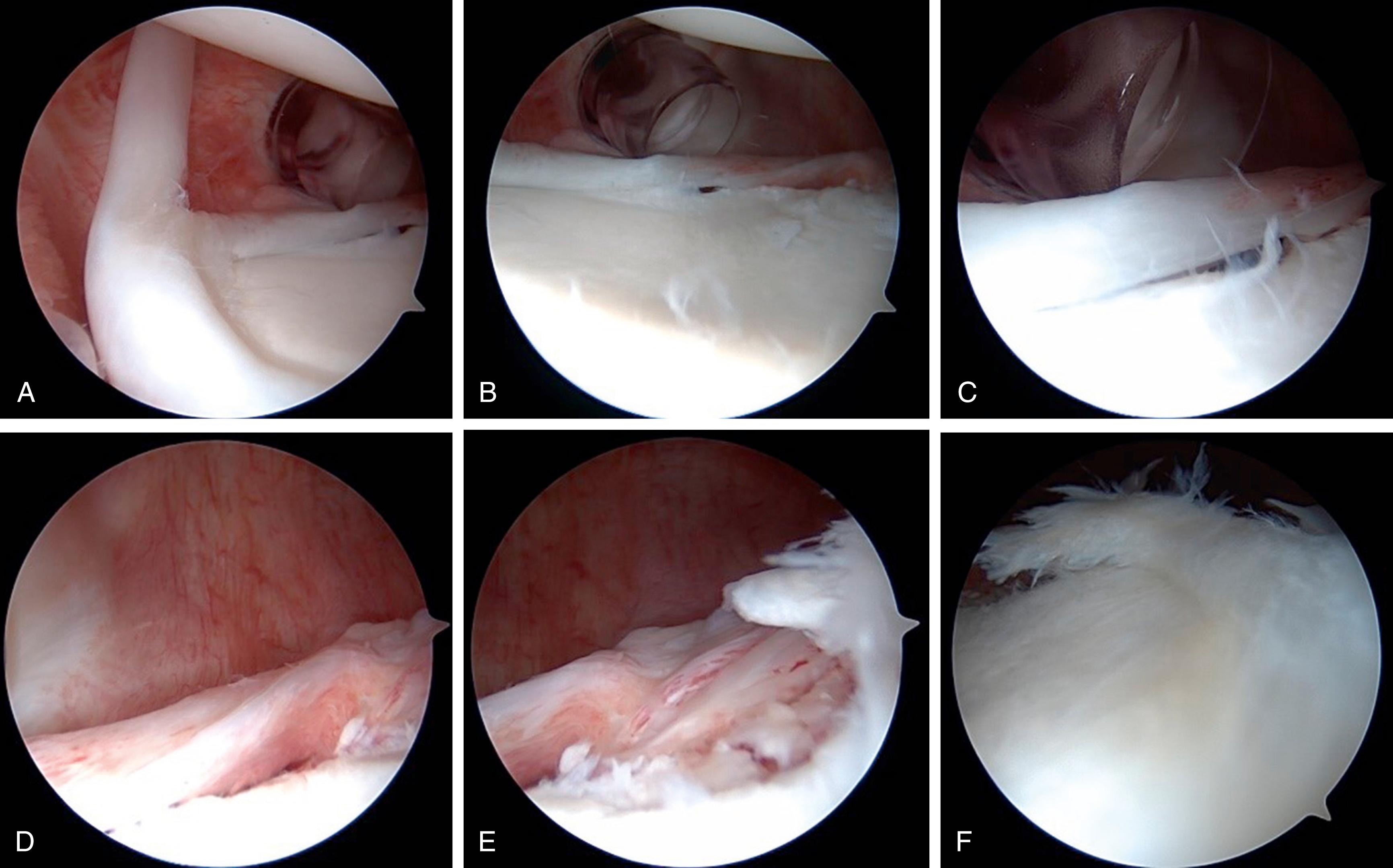 Fig. 20.2, Arthroscopic viewing from the posterior viewing portal of the right shoulder of a 16.5-year-old patient with recurrent instability. (A) The superior labrum and long head of biceps tendon are seen, along with a cord-like middle glenohumeral ligament. (A–C) A cannula is seen in the anterior working portal, low in the rotator cuff interval. (D–F) The labral tear is easily identified, beginning in the 3-o’clock position and continuing inferiorly and posteriorly to the 6-o’clock position. (F) Fraying of the labrum is also viewed, particularly in the inferior aspect of glenoid.