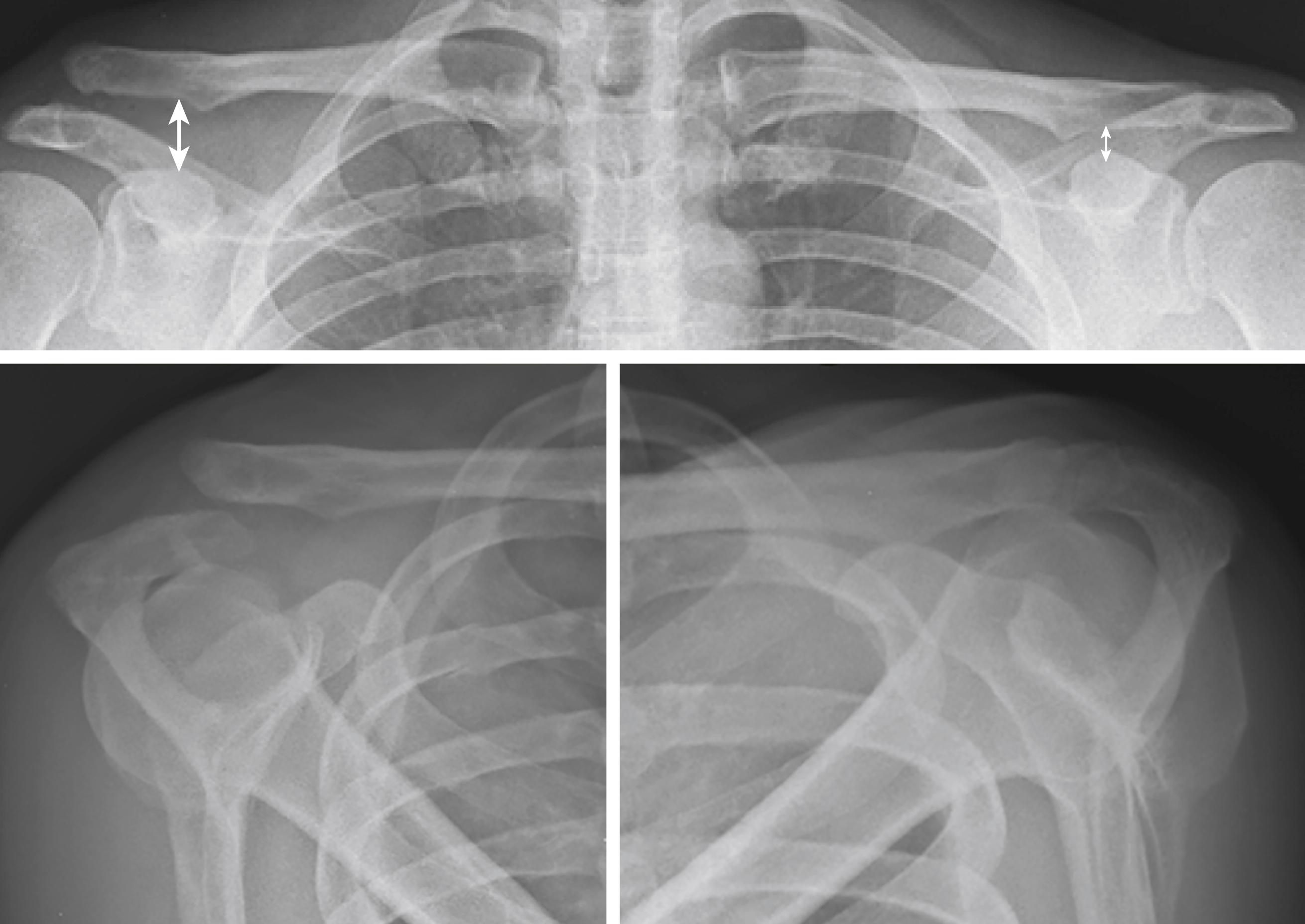 Fig. 13.1, Bilateral anteroposterior stress views (coracoclavicular distance marked with arrows ) and Alexander views of a patient with a high-grade bidirectional acromioclavicular joint dislocation (type V according to Rockwood).