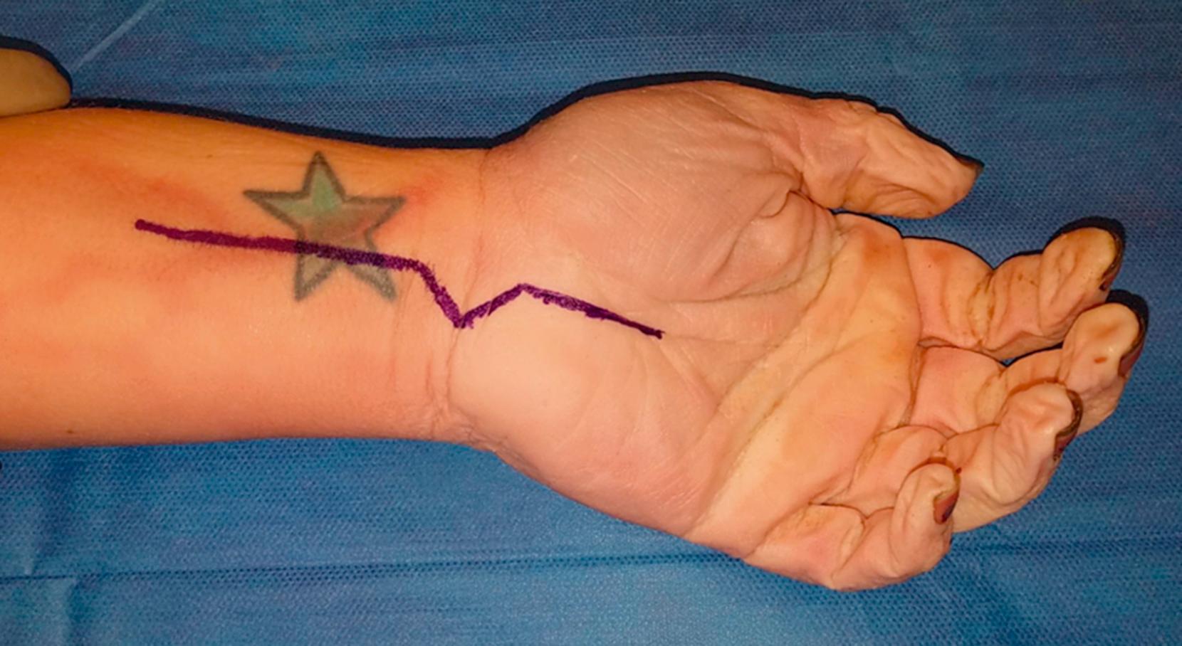 Fig. 69.1, Skin marking for extended carpal tunnel incision.