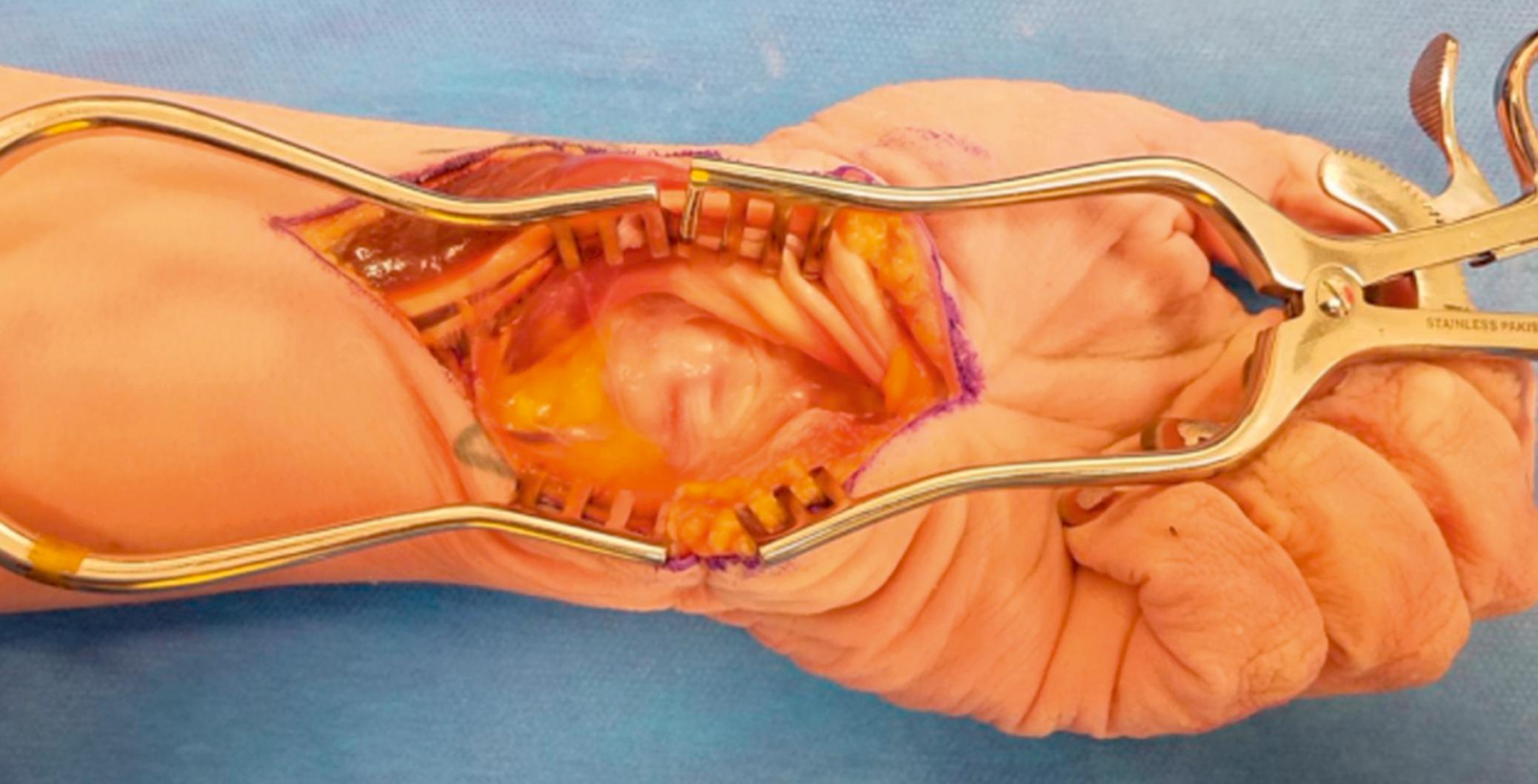 Fig. 69.2, After carpal tunnel release and release of the antebrachial fascia, the entire contents of the carpal tunnel are retracted radially, providing excellent visualization of the volar wrist capsule and radiocarpal ligaments.