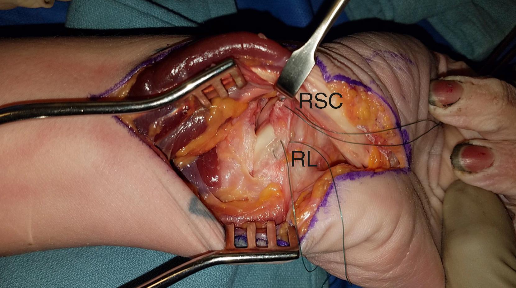 Fig. 69.3, Suture tags in the radiolunate (RL) and radioscaphocapitate (RSC) ligaments demonstrating the ease of visualization and repair from extended carpal tunnel approach.