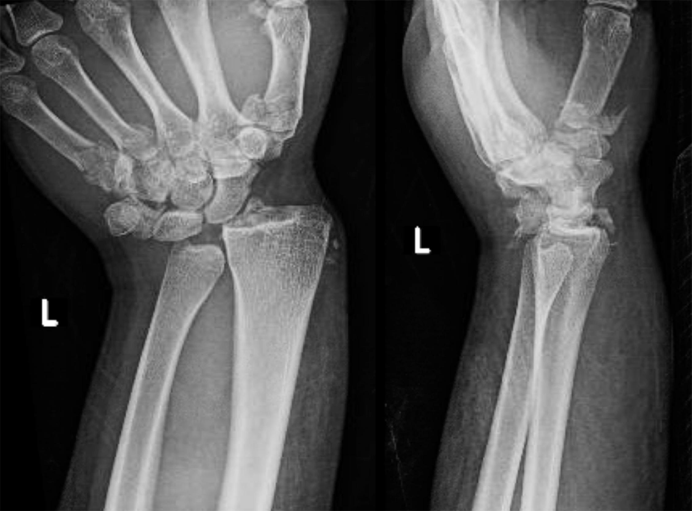 Fig. 69.4, Dumontier Type I with additional carpal and metacarpal injuries.