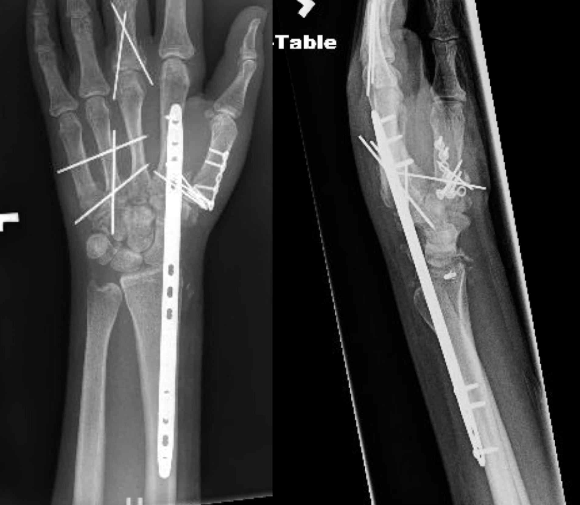 Fig. 69.5, Dumontier Type I with dorsal approach for dorsal spanning plate and volar approach to repair the important volar radiocarpal ligaments.